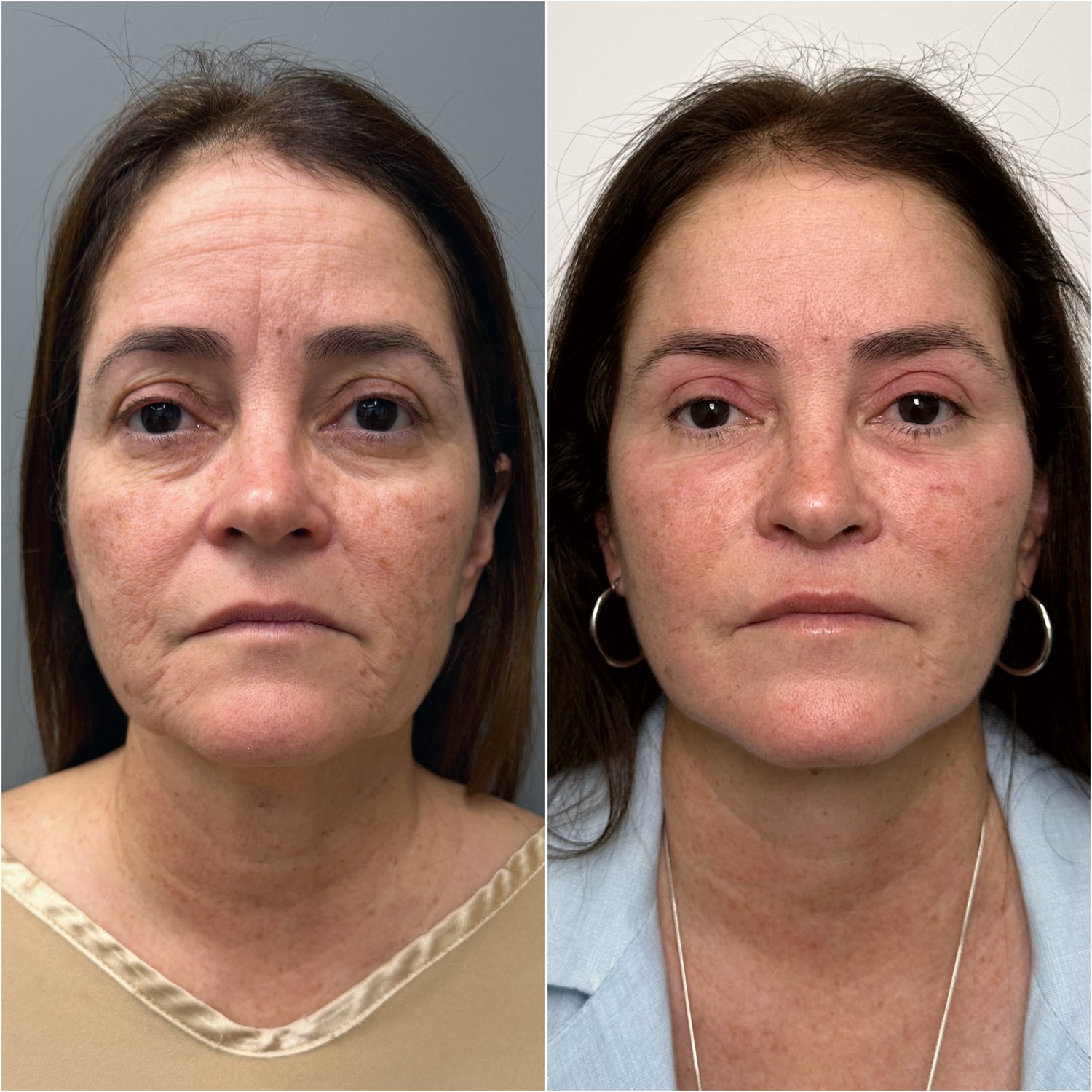 Deep Plane Facelift & Neck Lift before and after · frontal view