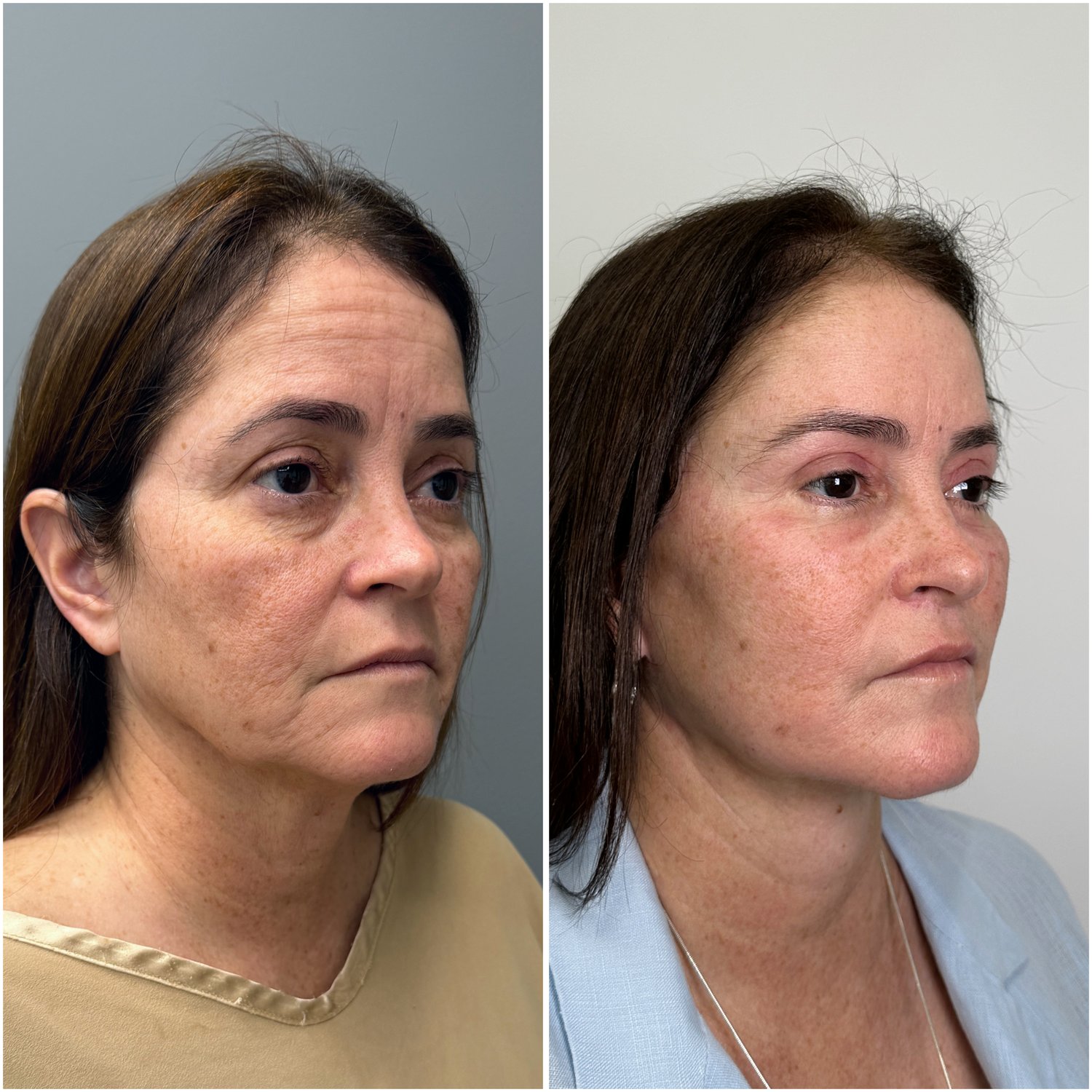 Before and after &mdash; The Masterpiece Surgery&trade;, oblique view
