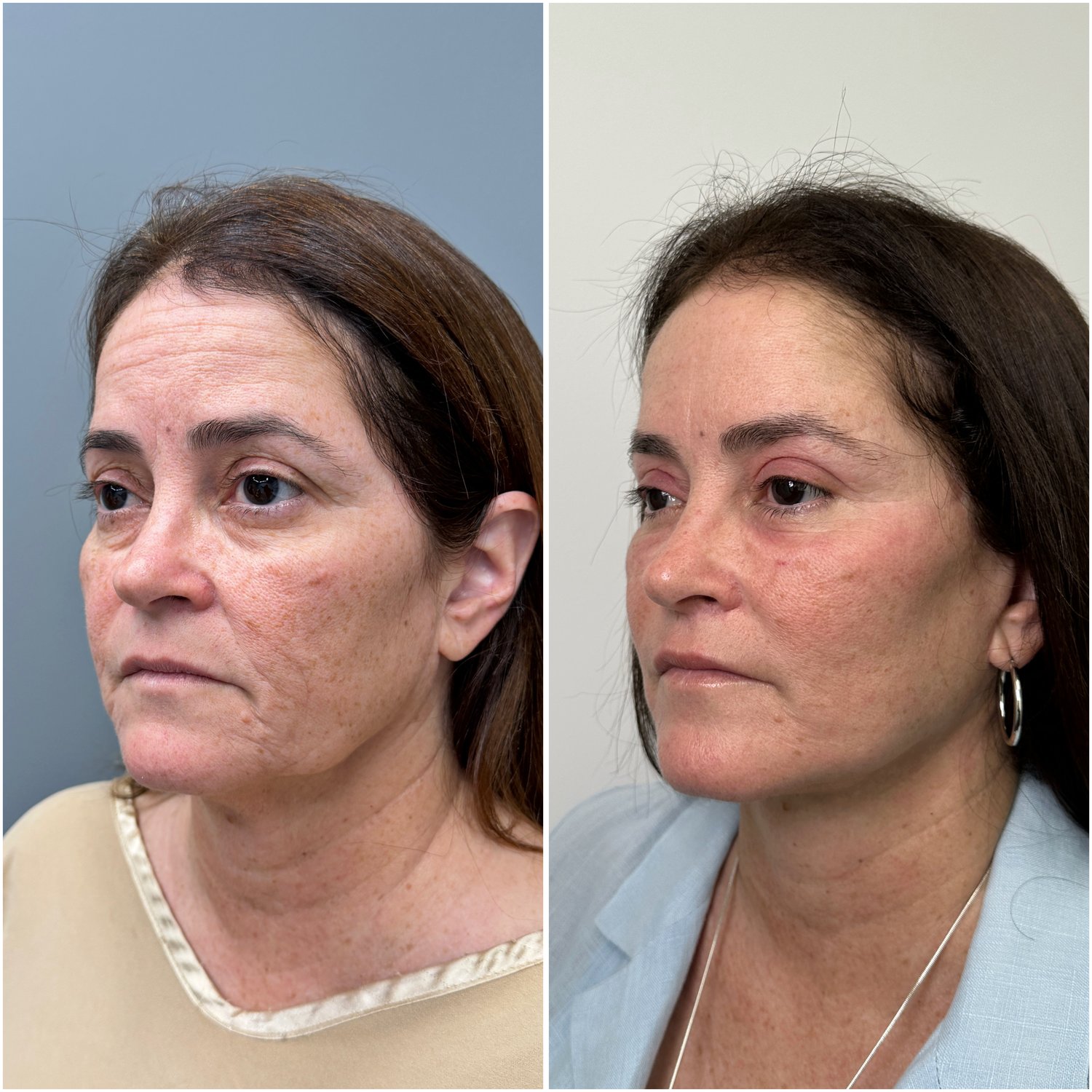 Before and after &mdash; The Masterpiece Surgery&trade;, profile view
