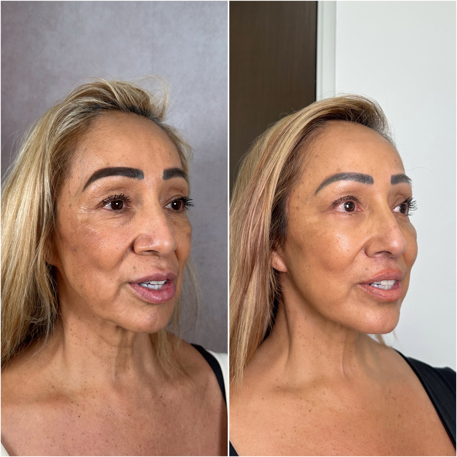 Before and after &mdash; The Masterpiece Surgery&trade;, oblique view
