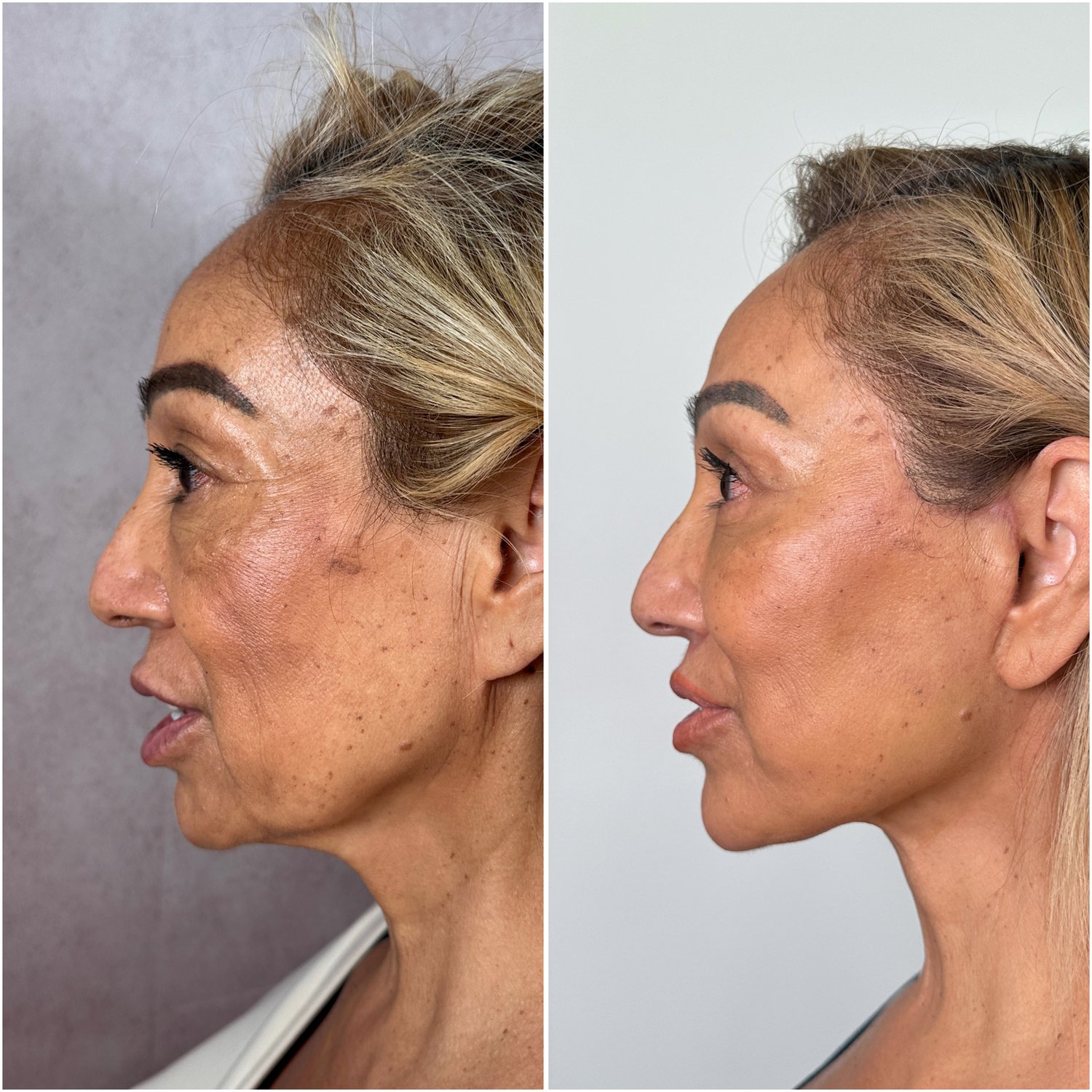 Before and after &mdash; The Masterpiece Surgery&trade;, profile view