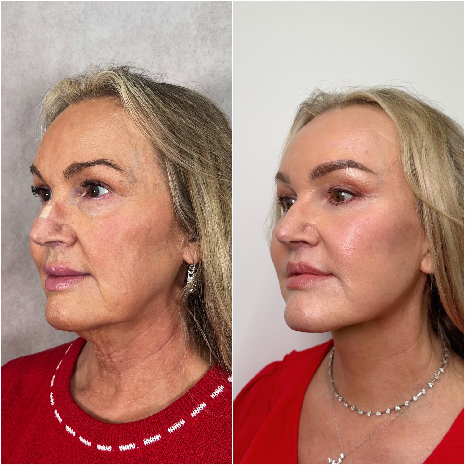 Before and after &mdash; The Masterpiece Surgery&trade;, oblique view
