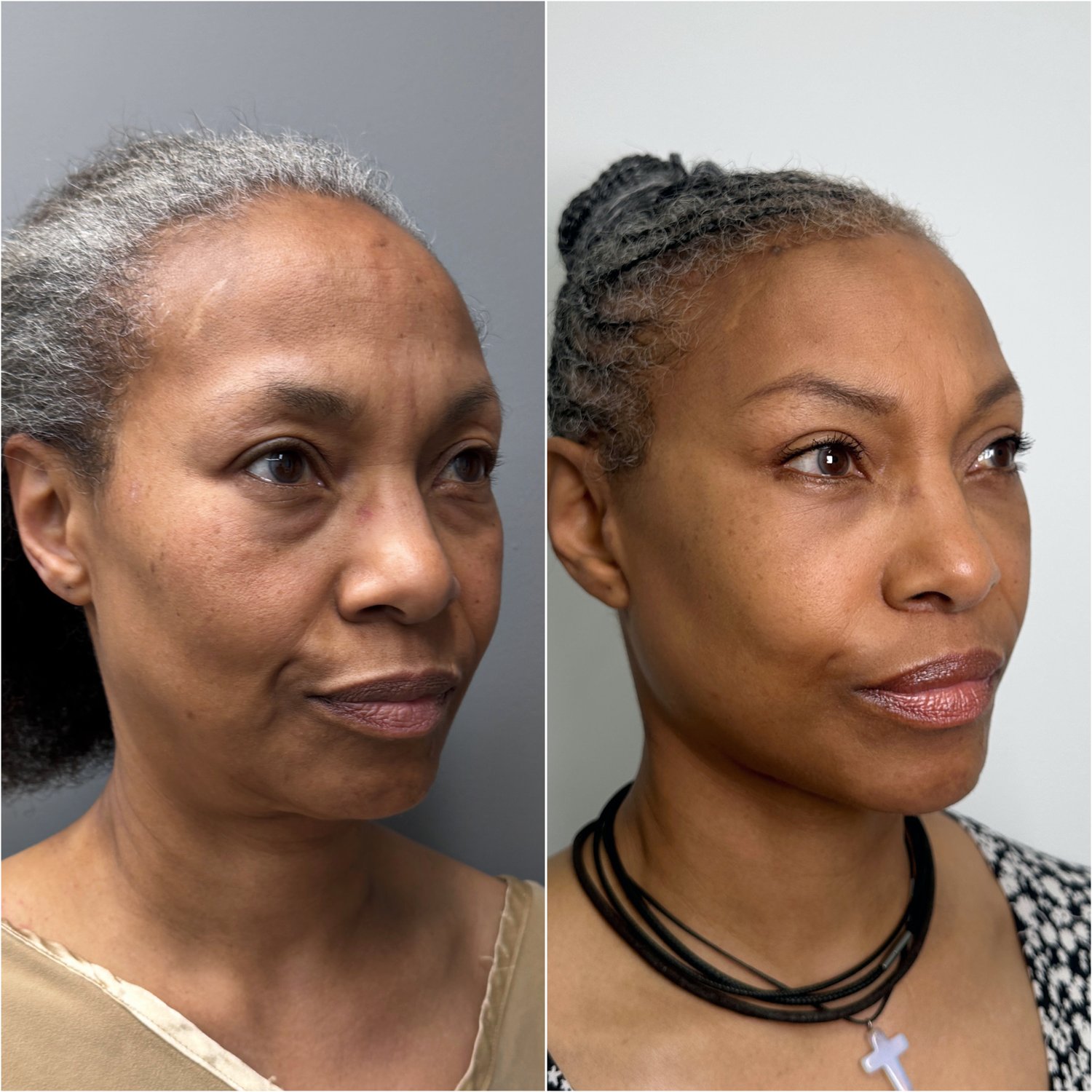 Deep Plane Facelift & Neck Lift before and after · frontal view