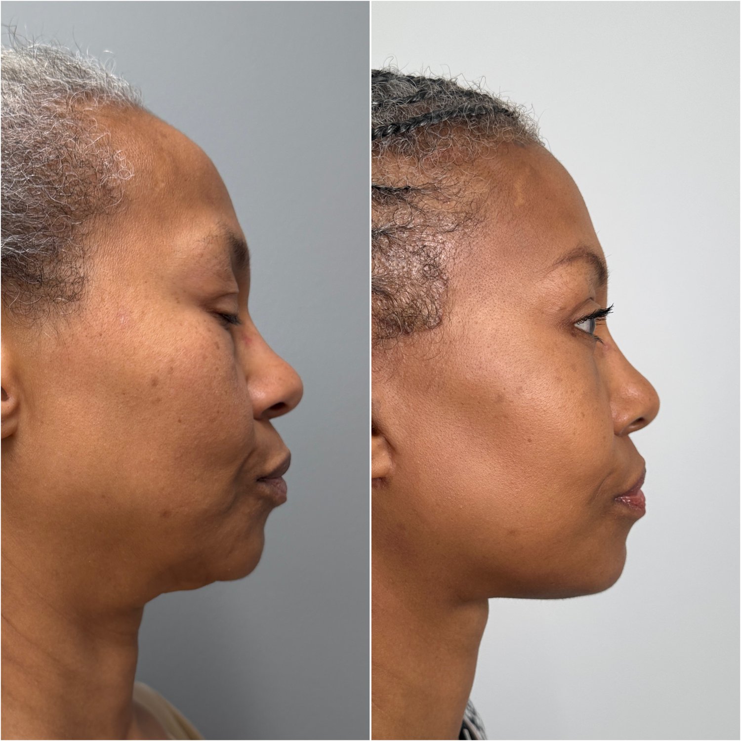 Before and after &mdash; The Masterpiece Surgery&trade;, profile view