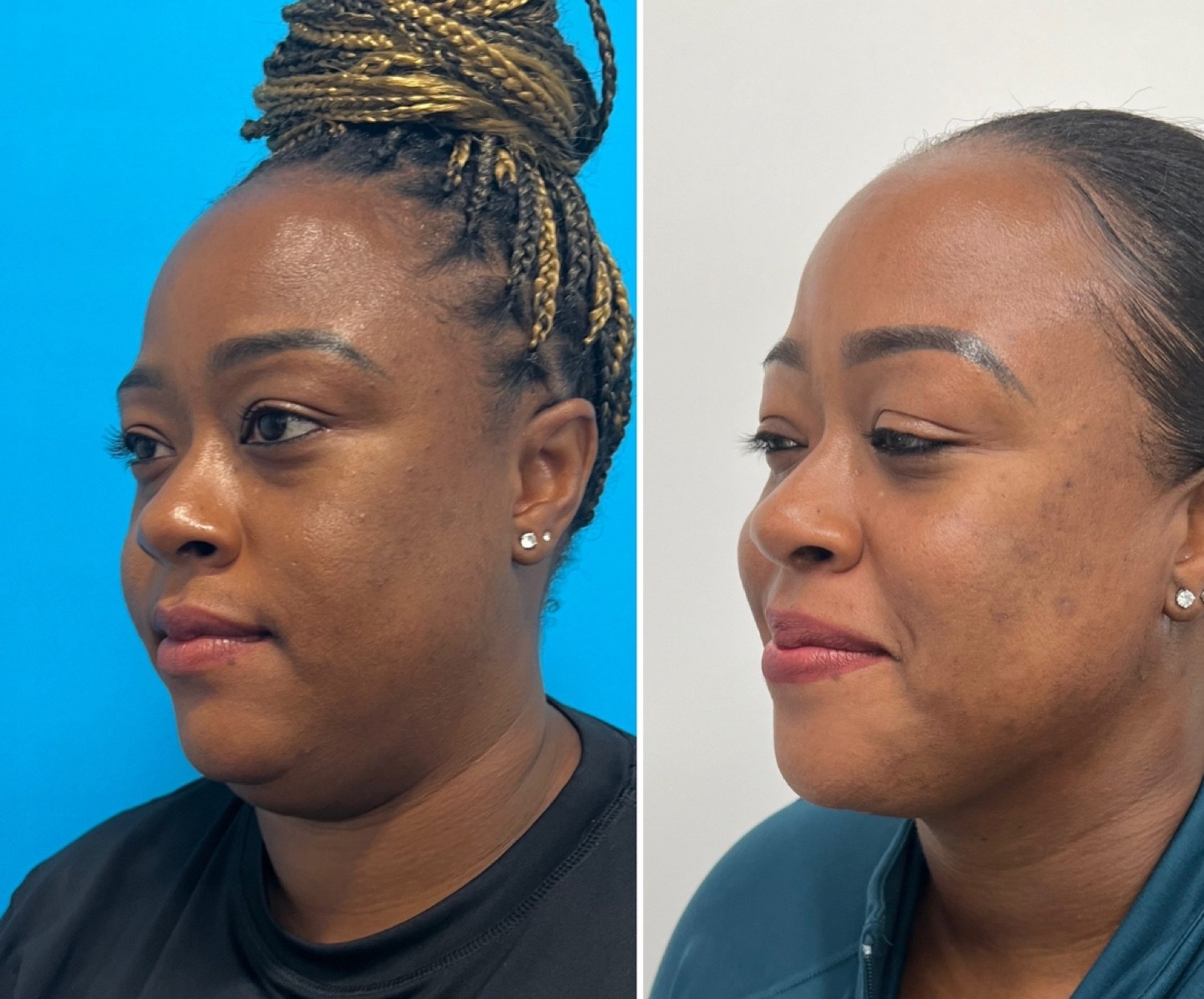 Neck Liposuction + FaceTite before and after &mdash; featured patient · before and after composite