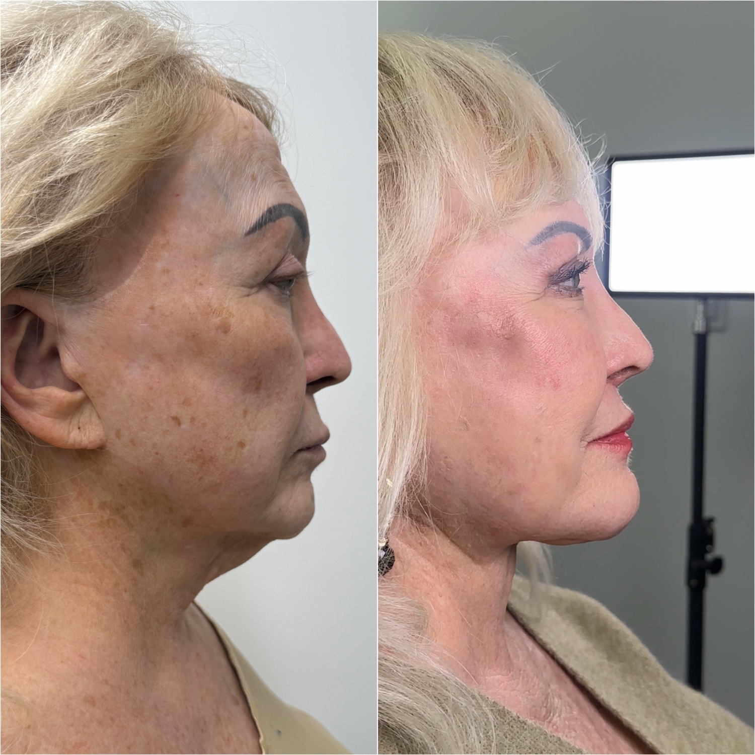 Before and after &mdash; revision facelift and neck lift as part of The Masterpiece, frontal view