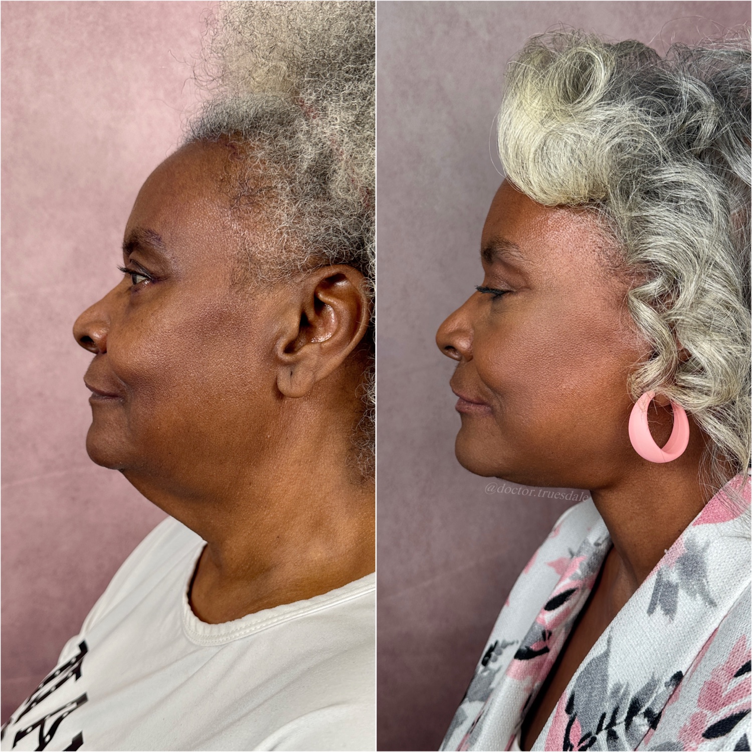 Deep Neck Lift as part of The Masterpiece Surgery&trade; before and after · profile view