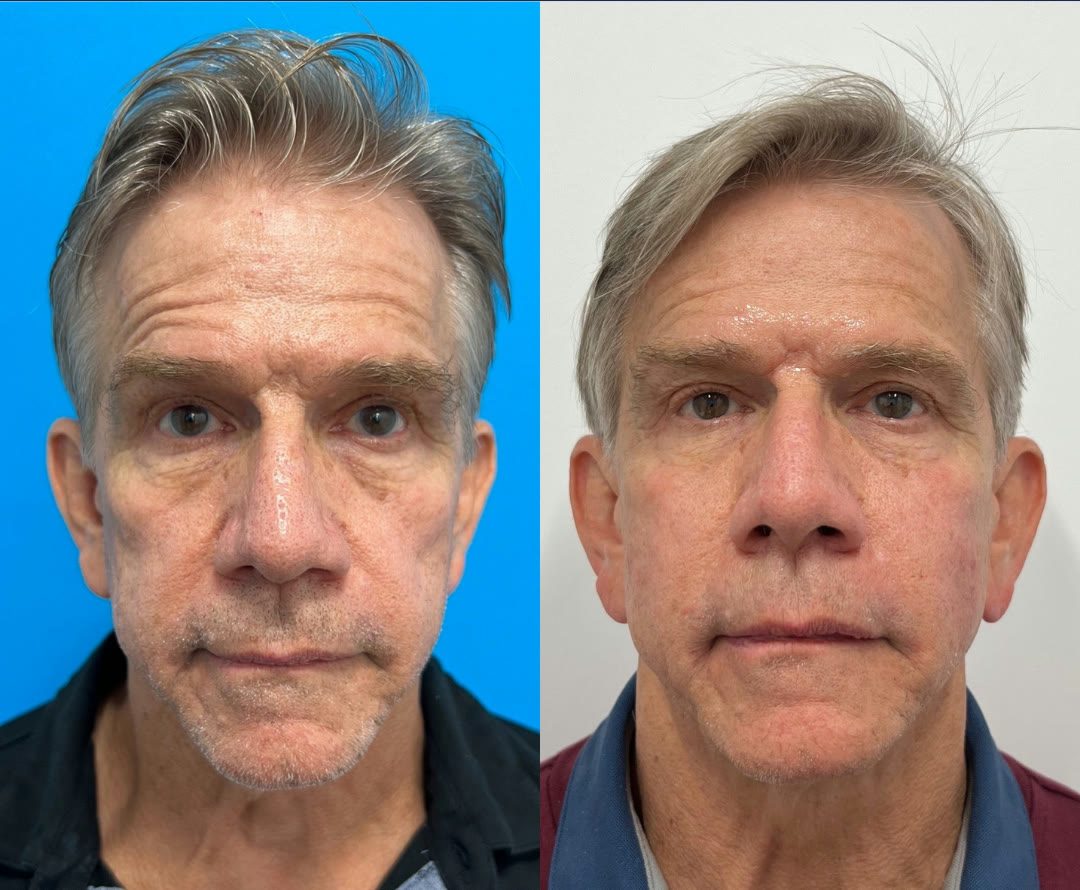 Cheek filler before and after &mdash; male · before and after composite