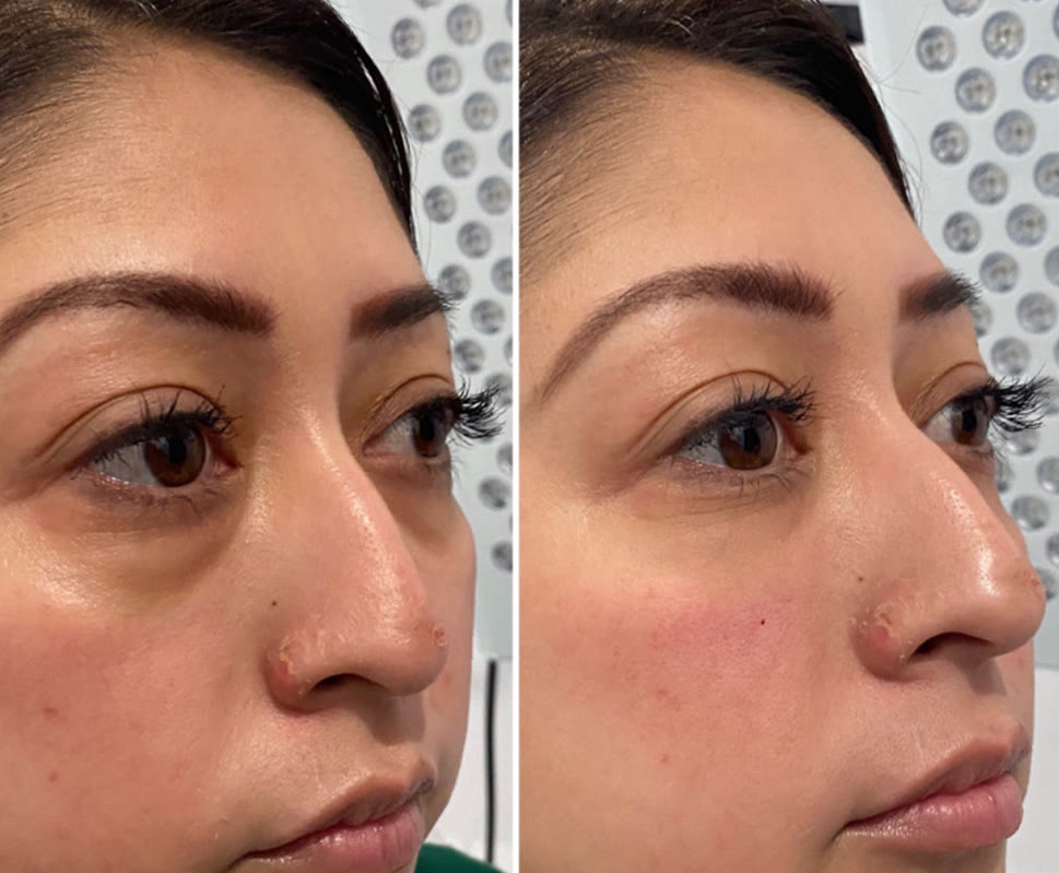 Eye / under-eye filler before and after, oblique view