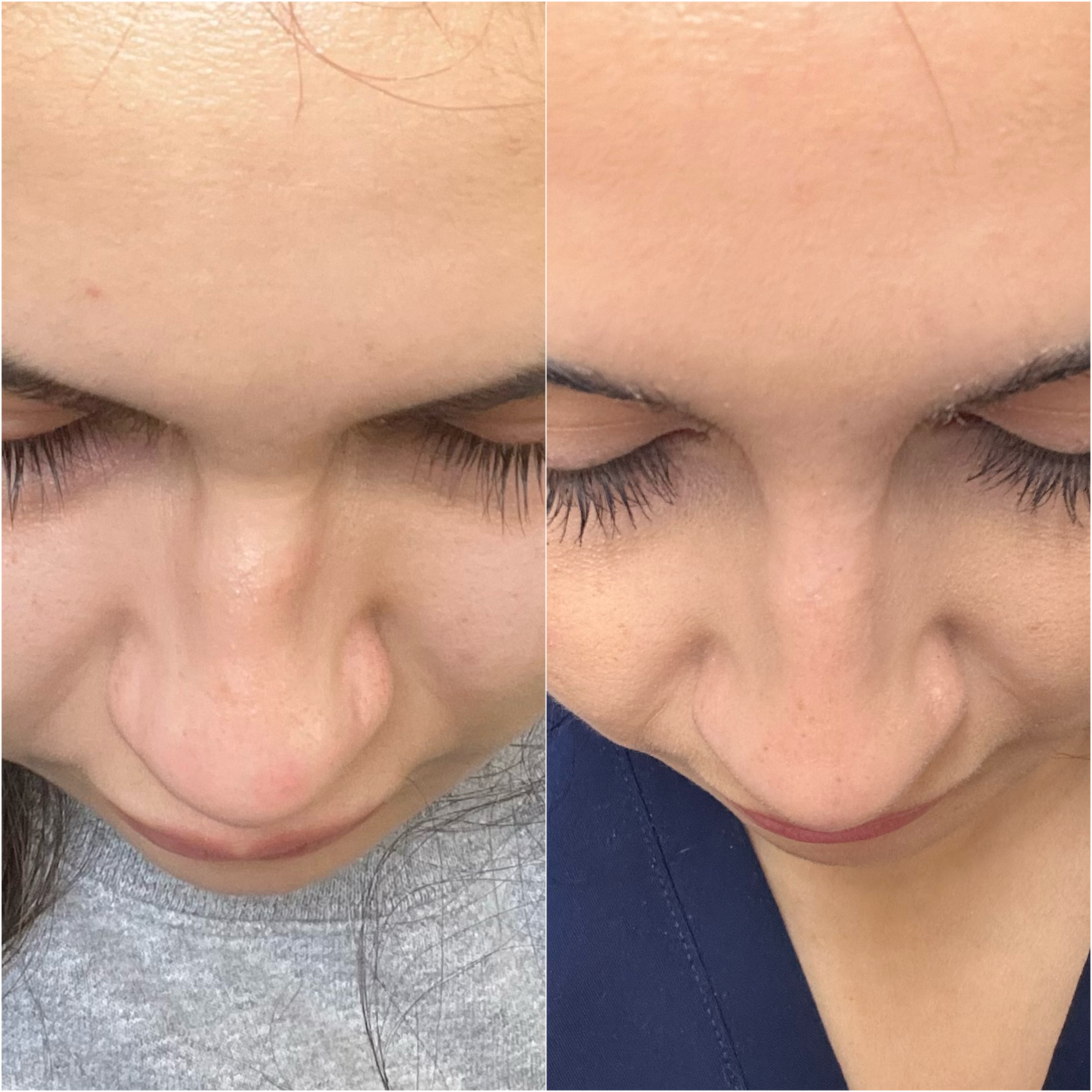 Dermal filler before and after · before and after composite