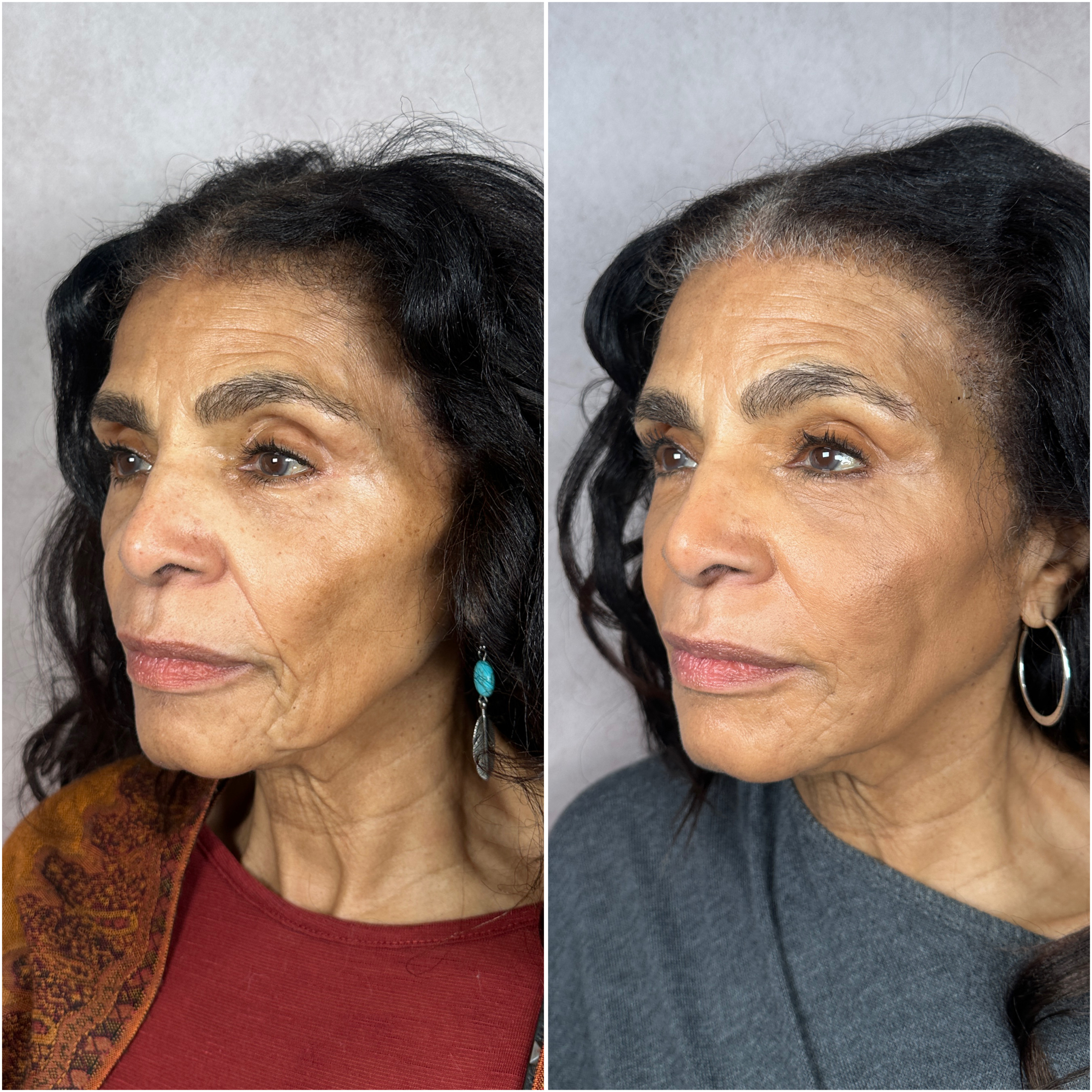 Dermal filler before and after · before and after composite
