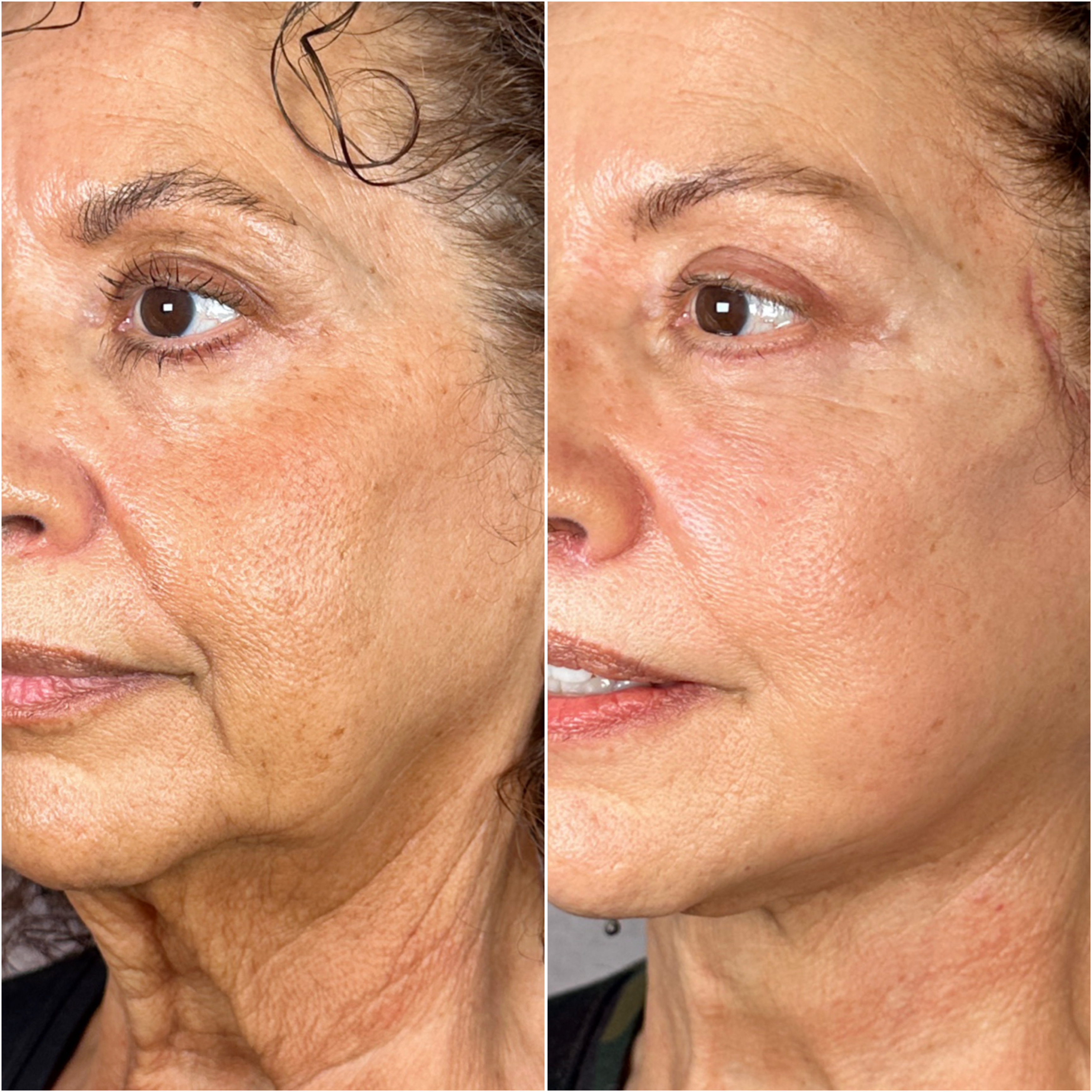 UltraClear laser before and after · before and after composite