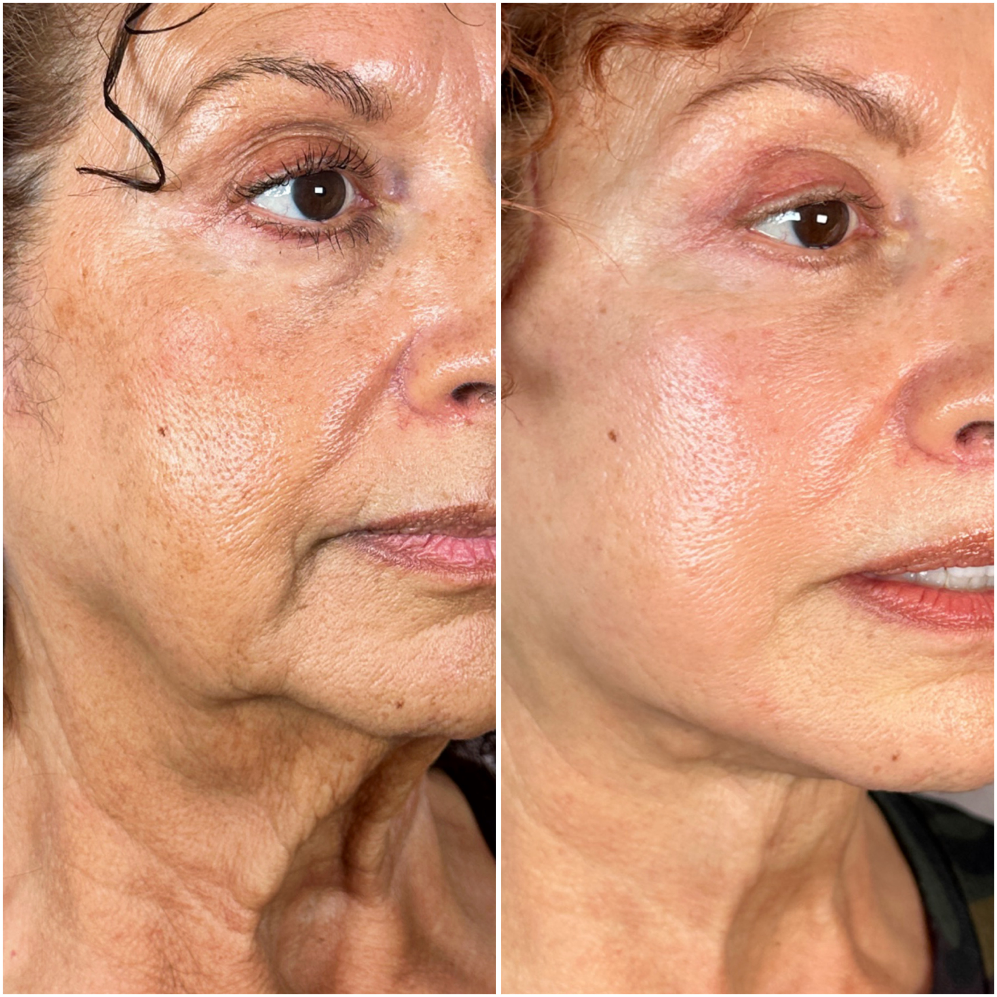 UltraClear laser before and after · before and after composite