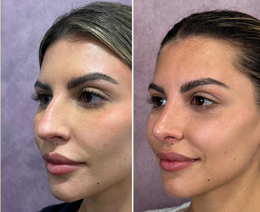 Rhinoplasty before and after &mdash; featured patient · before and after composite