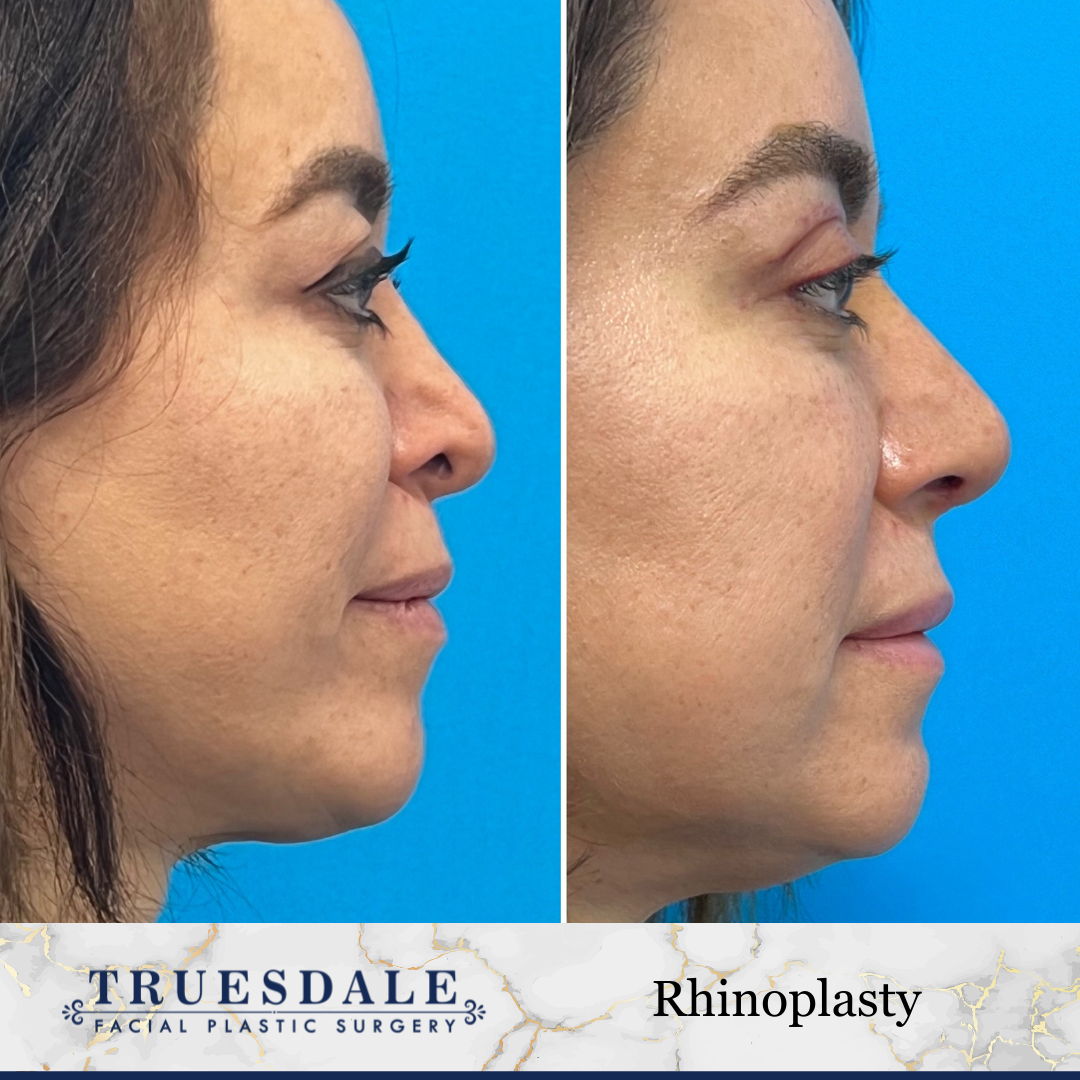 Before and after — rhinoplasty, profile view