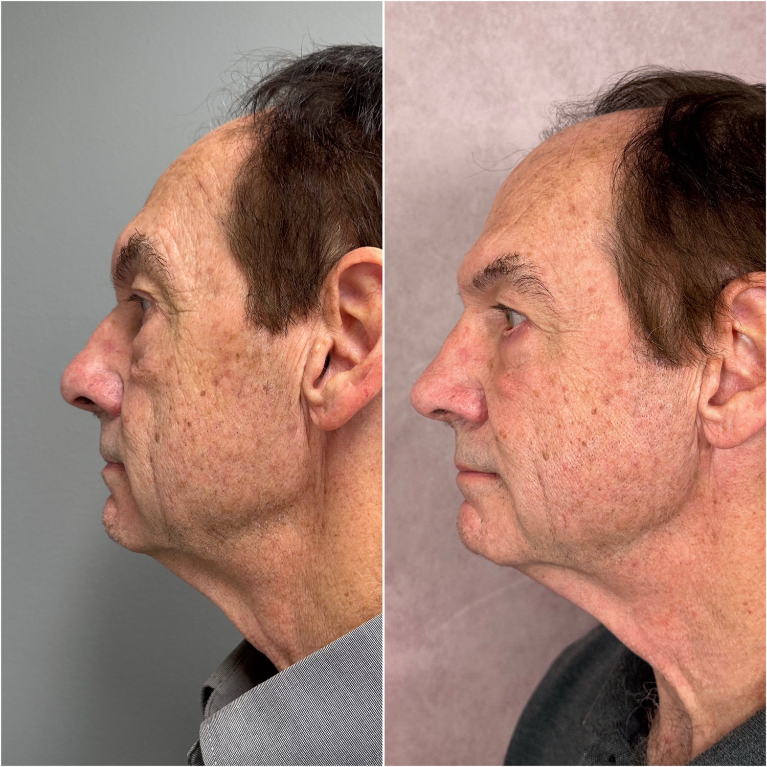 Before and after &mdash; rhinoplasty with facial rejuvenation, left profile view
