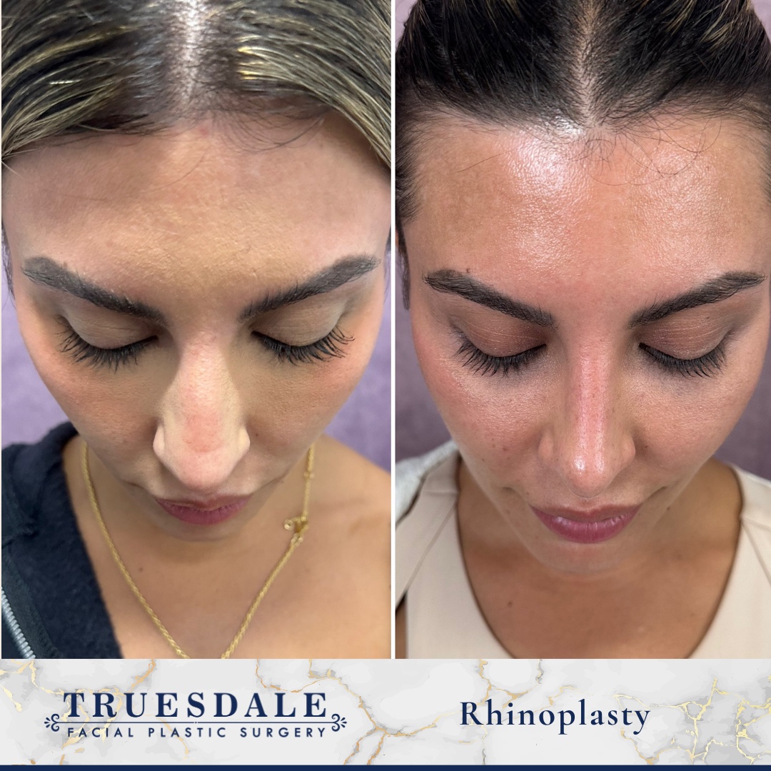 Before and after &mdash; rhinoplasty, base view