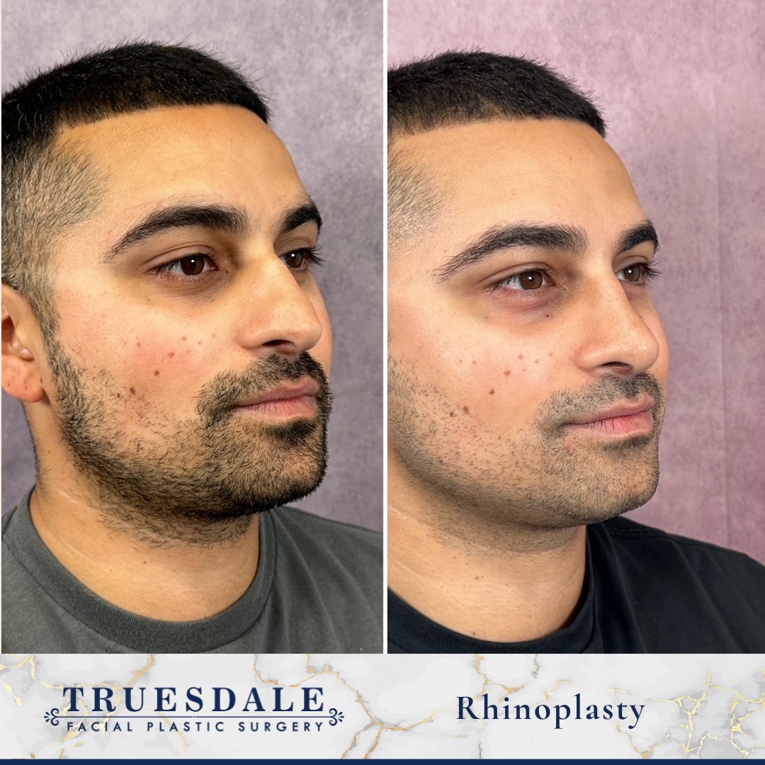 Before and after &mdash; male rhinoplasty, oblique view