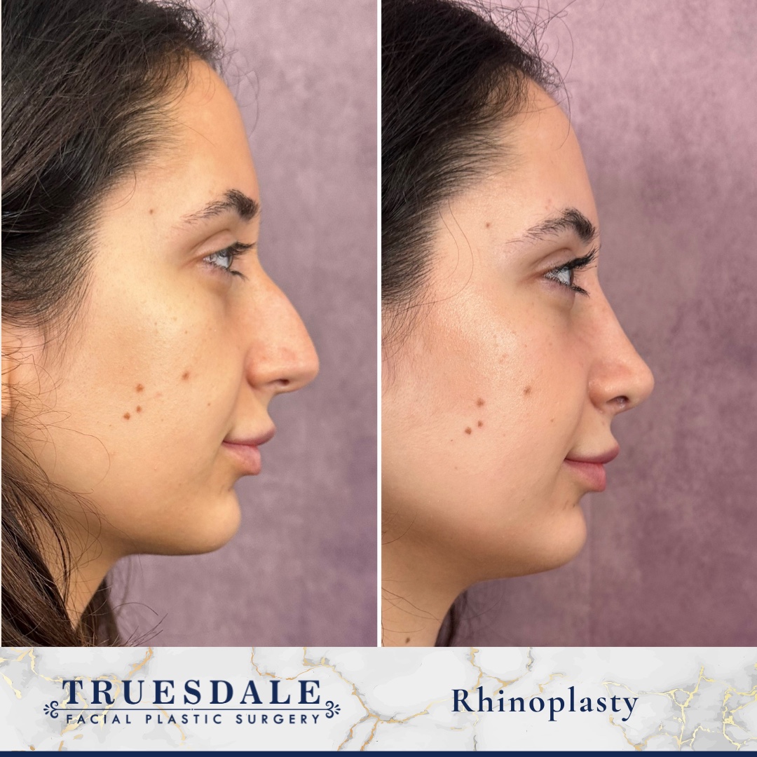 Before and after &mdash; rhinoplasty, profile view