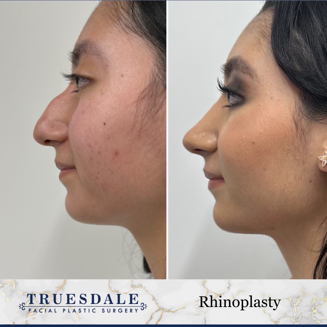Before and after &mdash; rhinoplasty, profile view