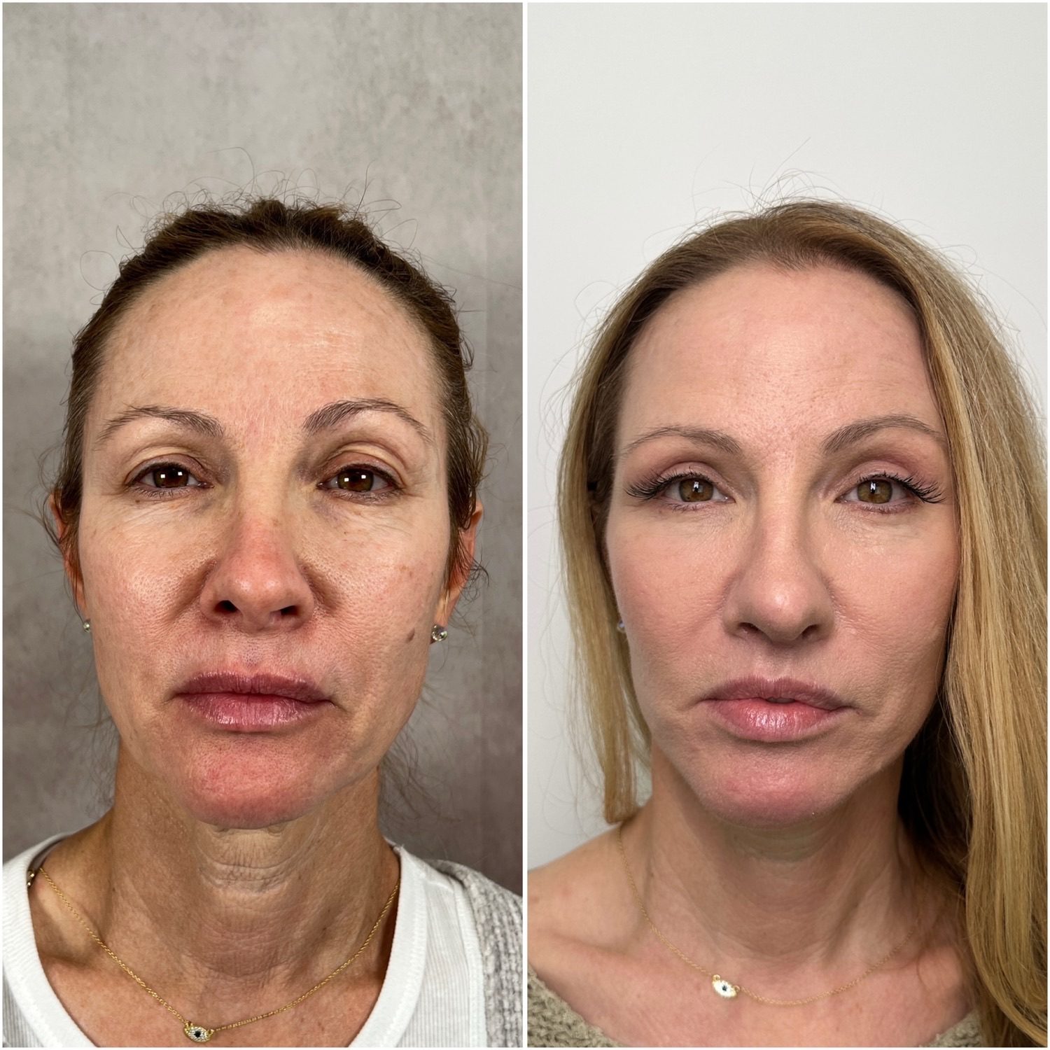 Revision rhinoplasty before and after · frontal view