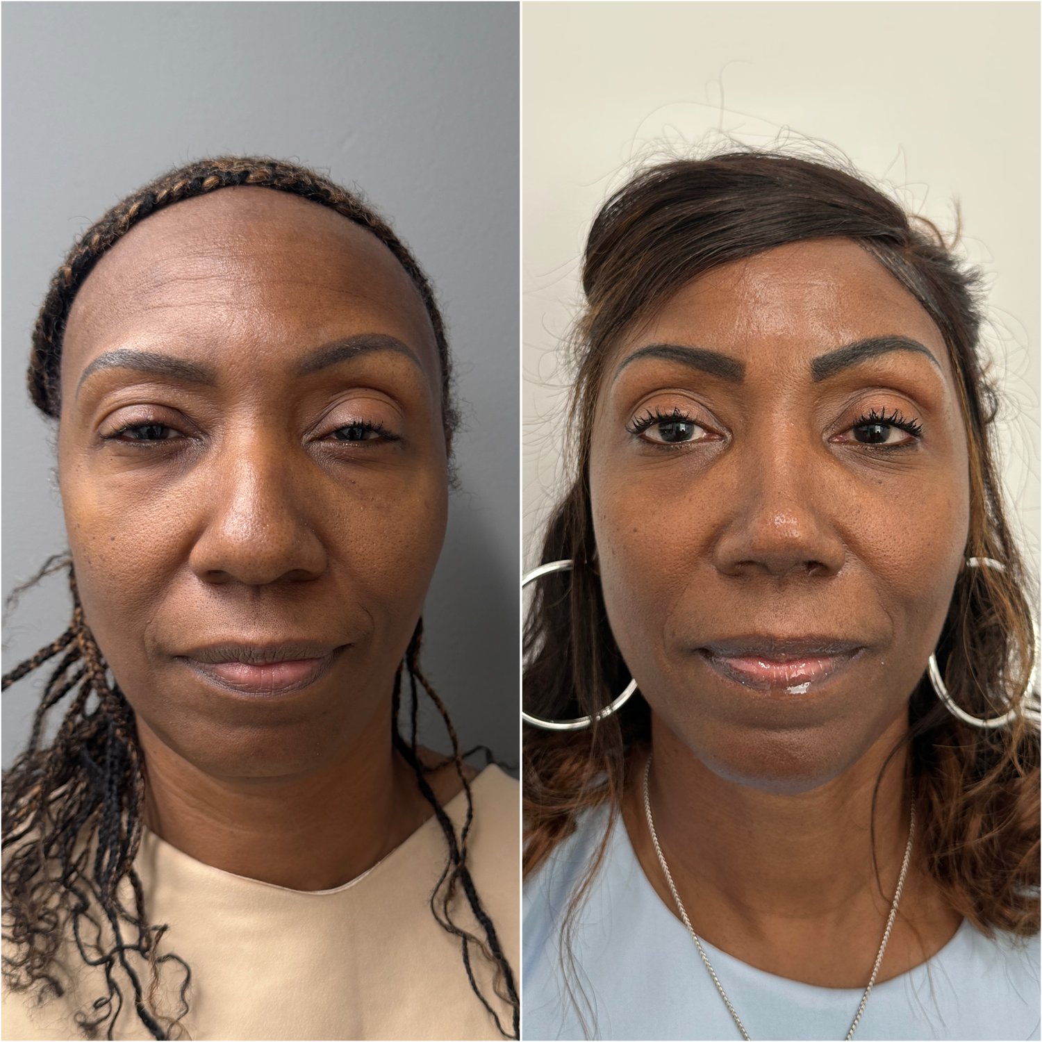 Rhinoplasty and chin implant before and after · frontal view