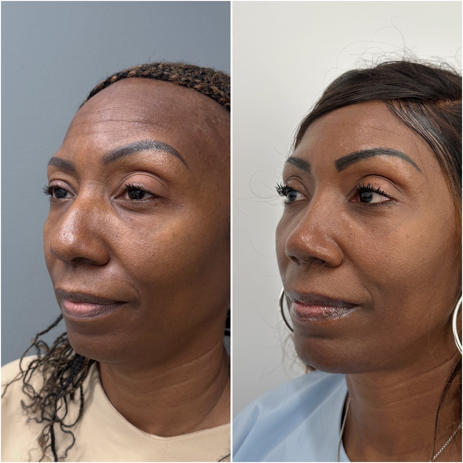 Before and after &mdash; rhinoplasty and chin implant, oblique view