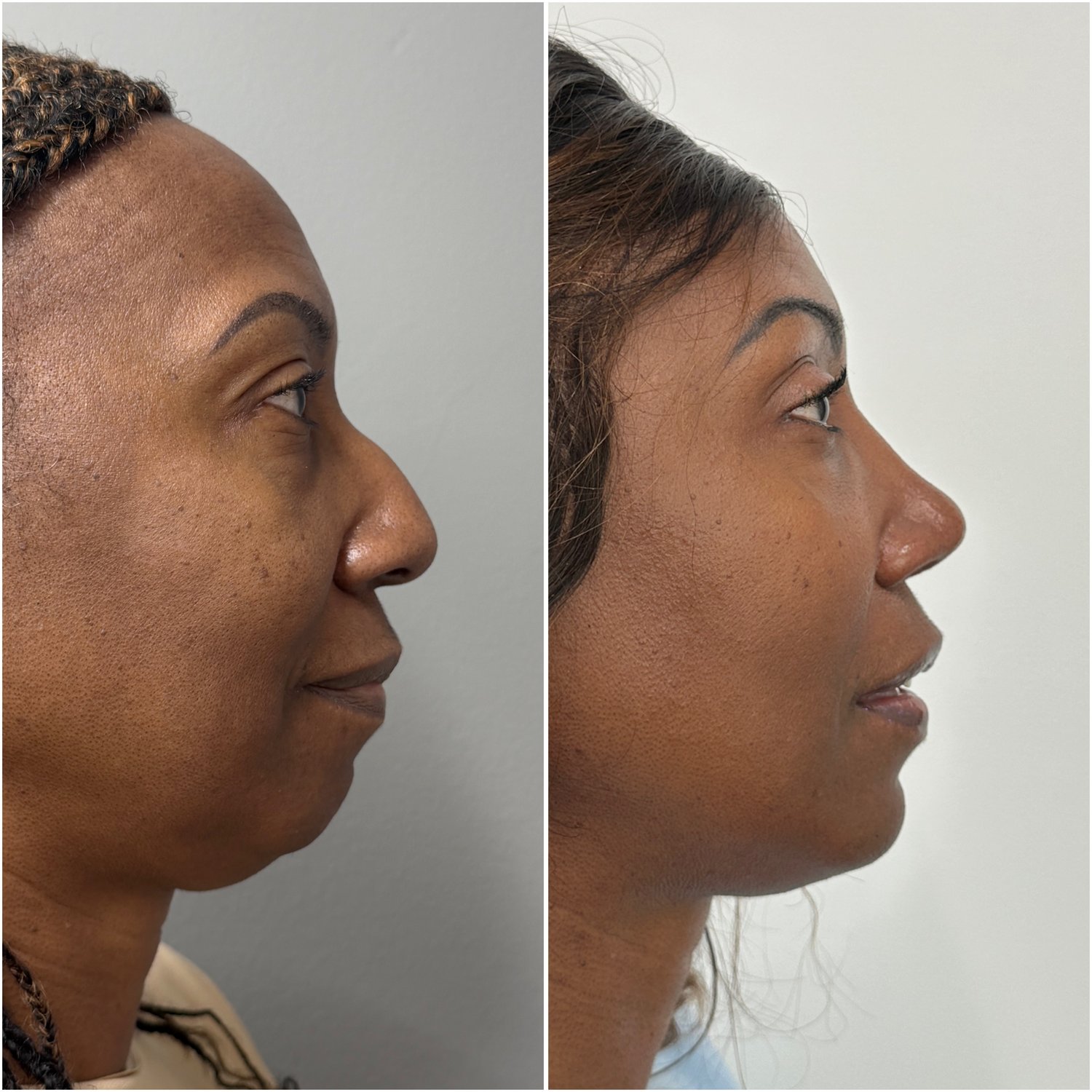 Before and after &mdash; rhinoplasty and chin implant, profile view