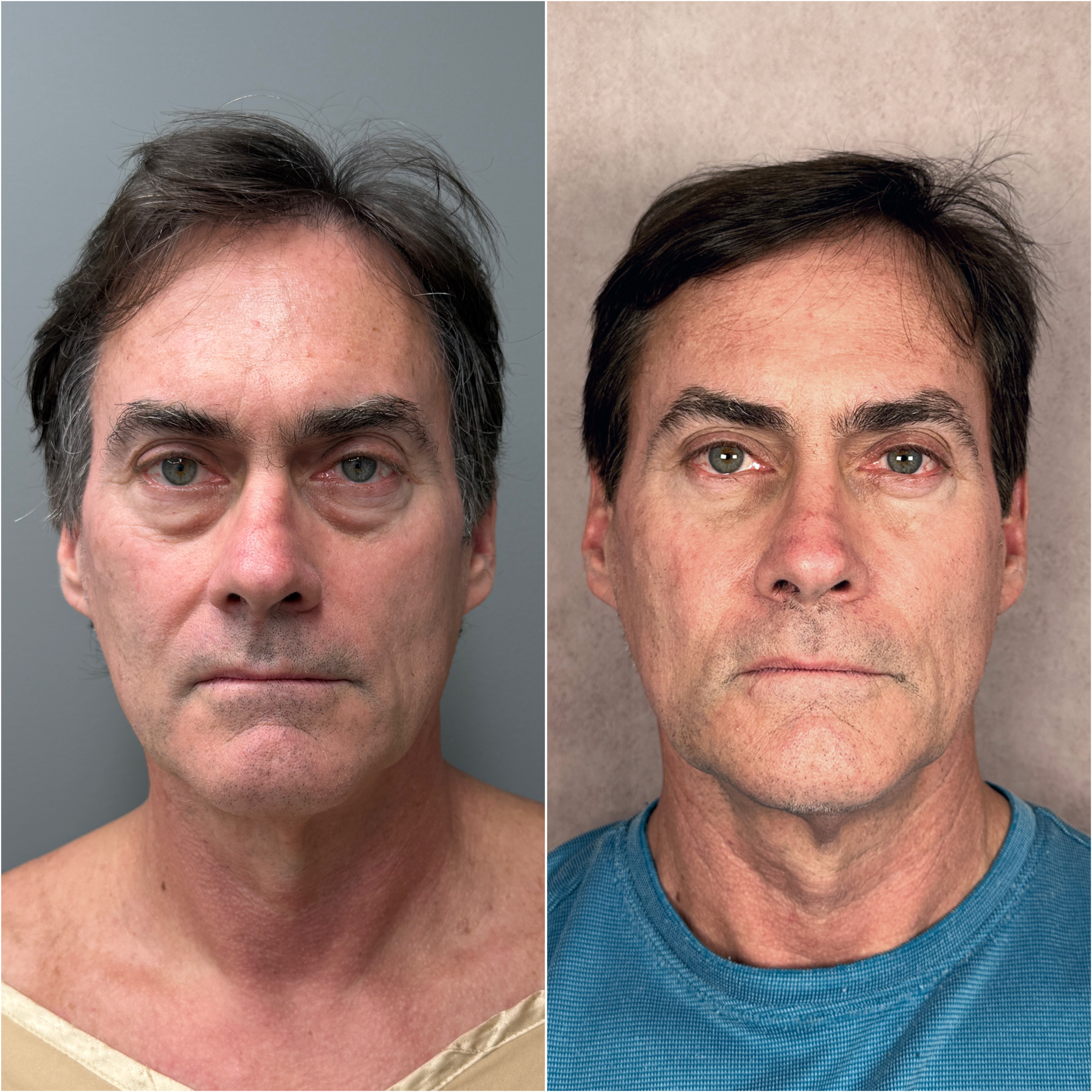 Lower blepharoplasty before and after