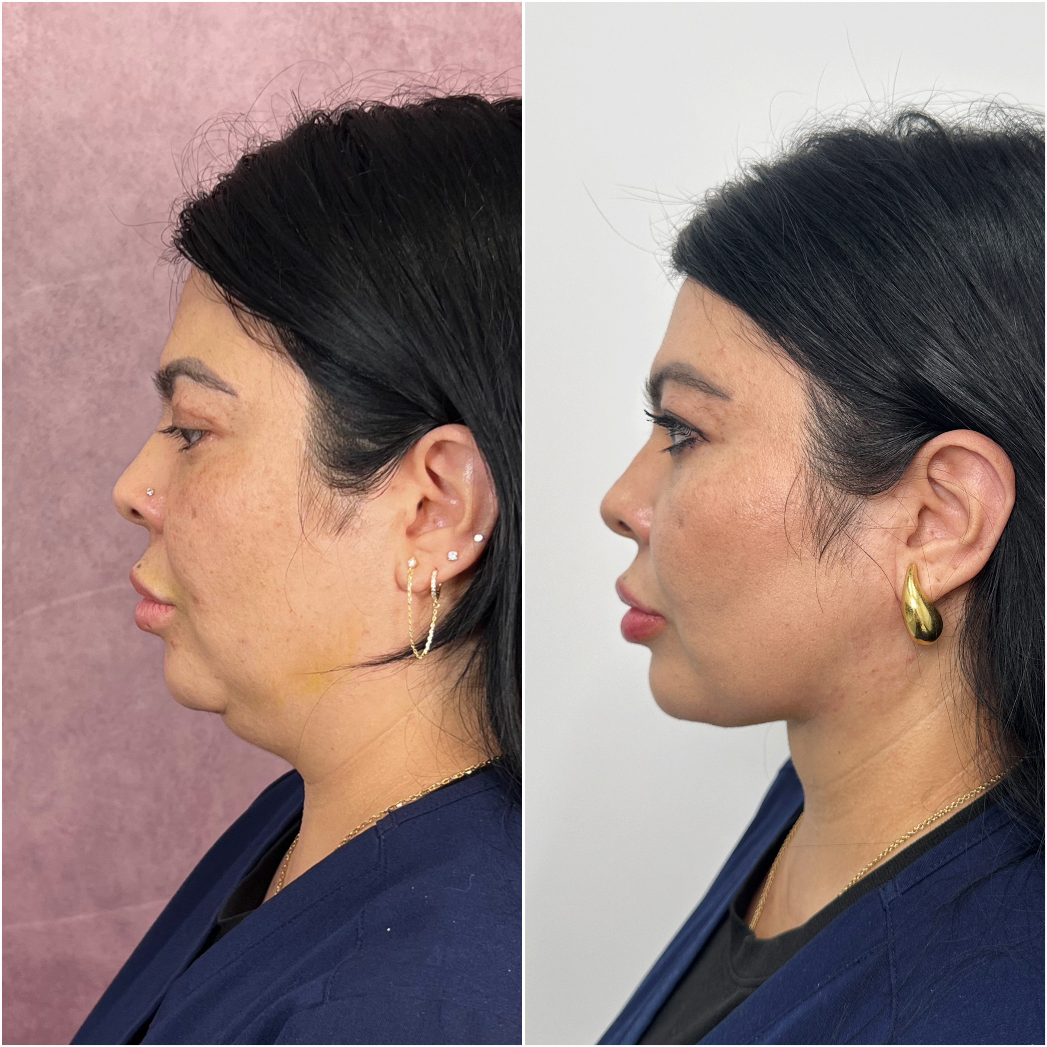 Deep Neck Lift before and after &mdash; sharper jaw-to-neck angle &middot; profile view