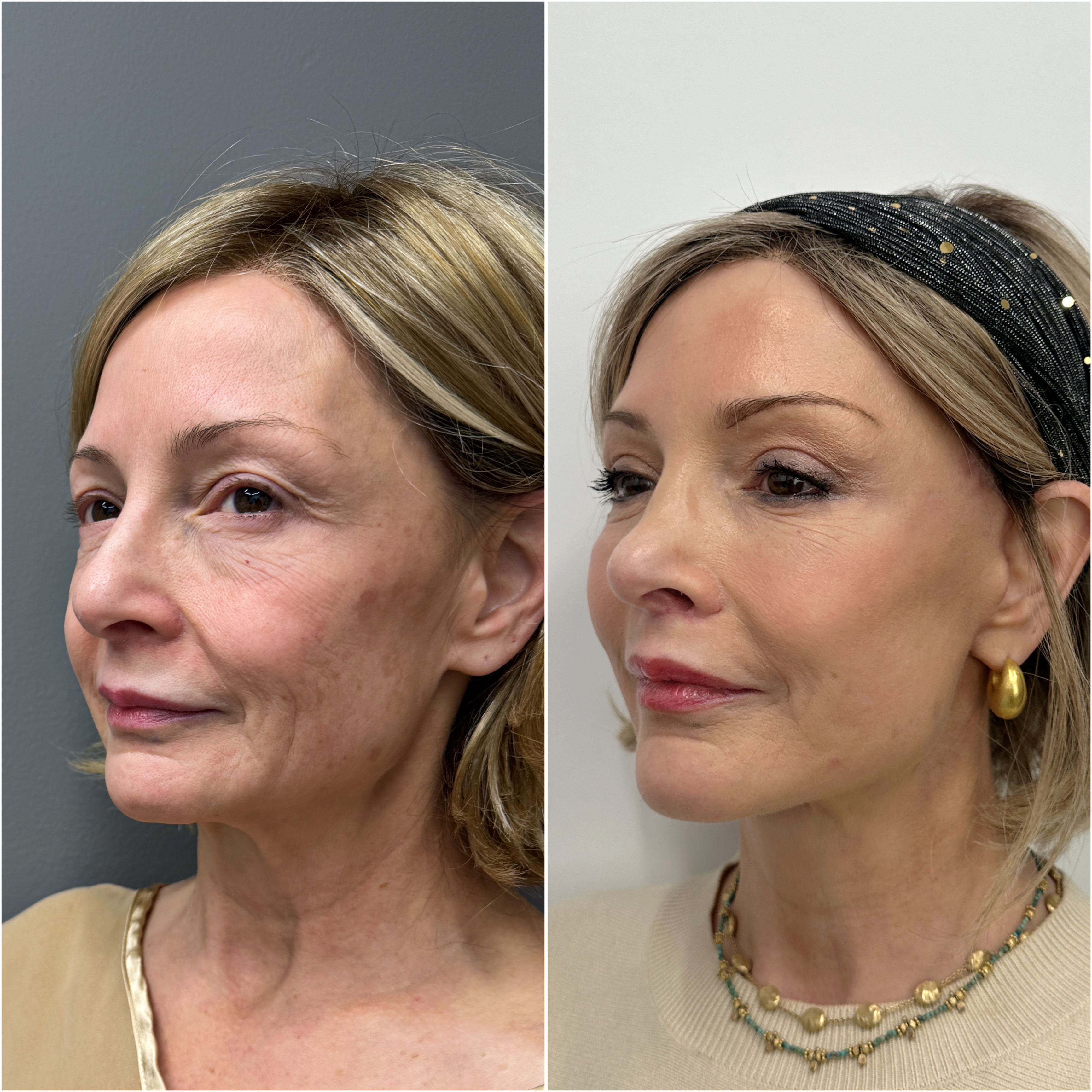 Upper blepharoplasty before and after &mdash; lifted, more youthful upper face