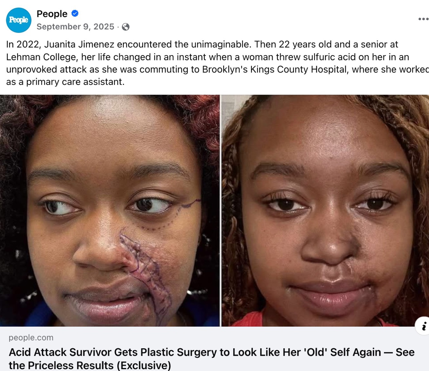 People Magazine feature: Acid Attack Survivor Gets Plastic Surgery to Look Like Her Old Self Again &mdash; Juanita Jimenez before and after reconstructive surgery by Dr. Carl Truesdale