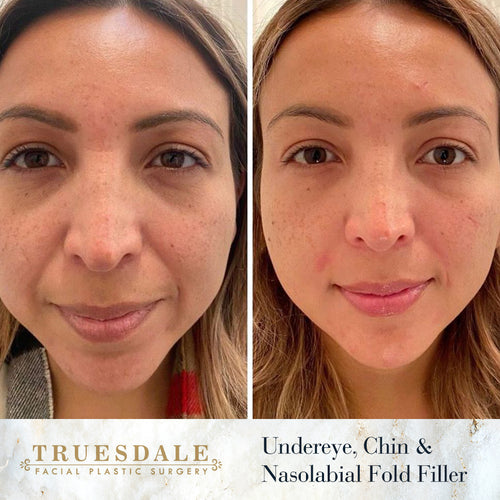 Truesdale Facial Plastic Surgery Before and After Gallery