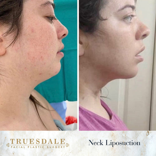 Truesdale Facial Plastic Surgery Before and After Gallery