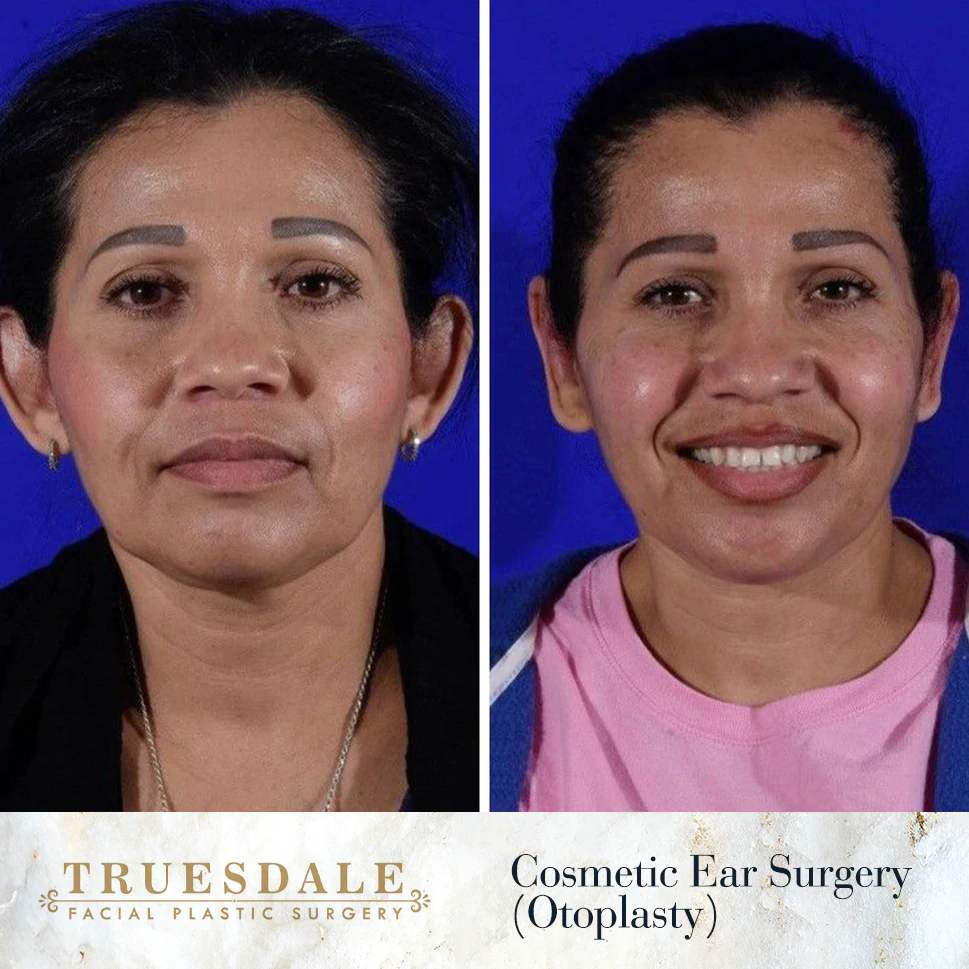 Truesdale Facial Plastic Surgery Before and After Gallery