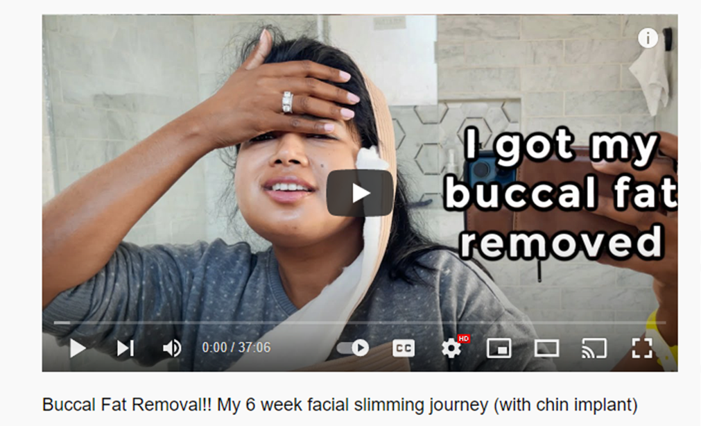 TamkinSpice – Buccal Fat Removal!! My 6 week facial slimming journey (with chin implant)