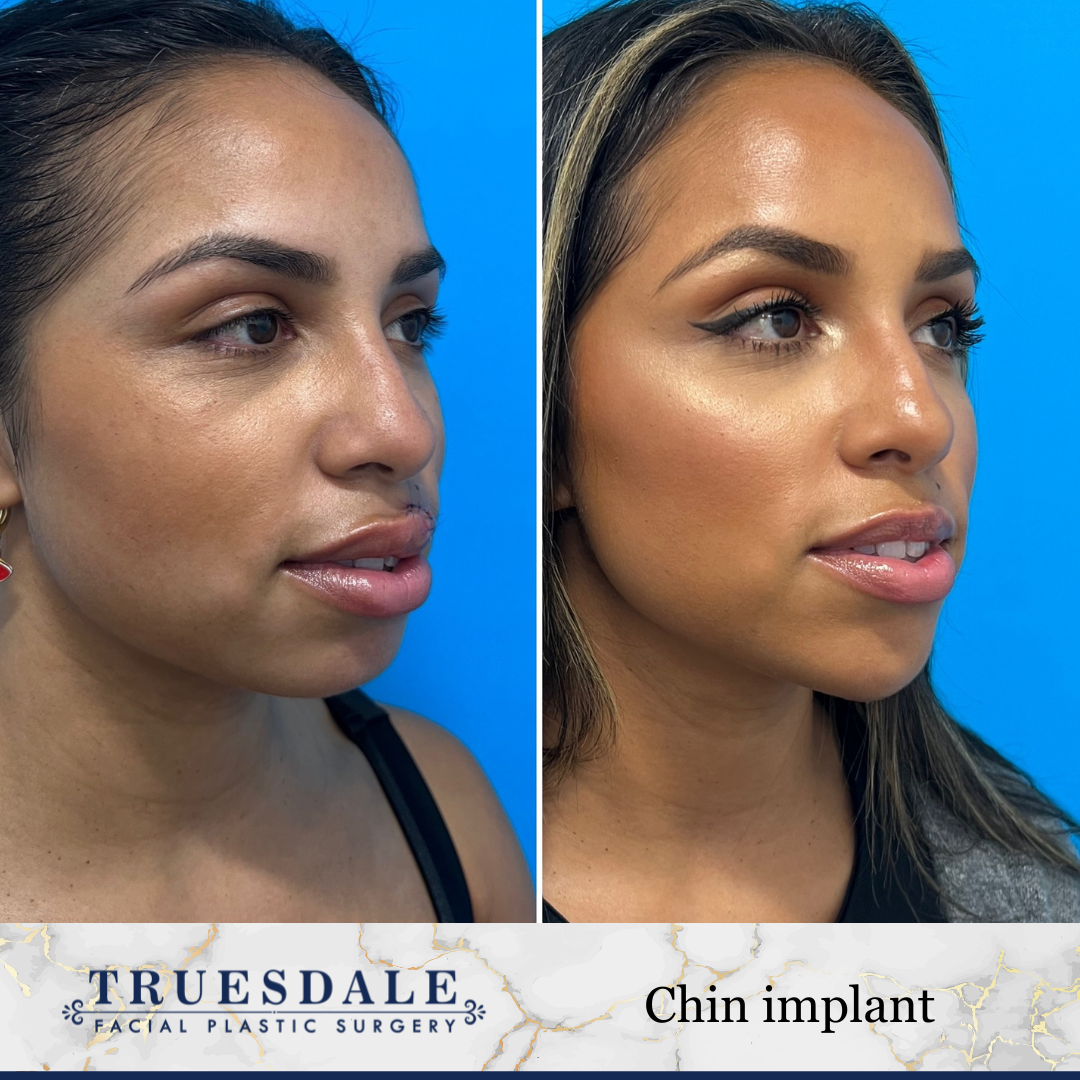 Truesdale Facial Plastic Surgery Before and After Gallery