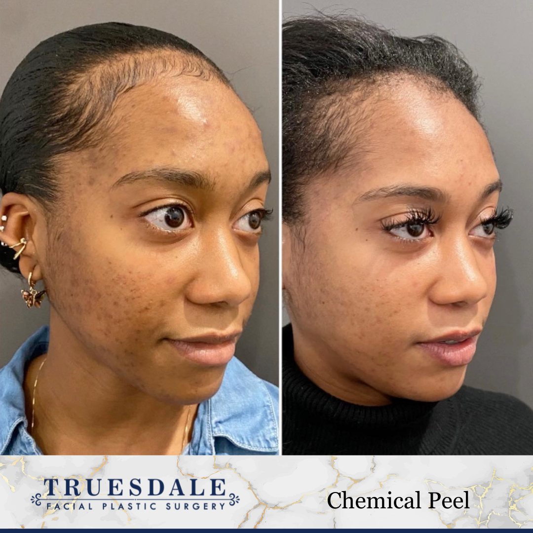 Truesdale Facial Plastic Surgery Before and After Gallery