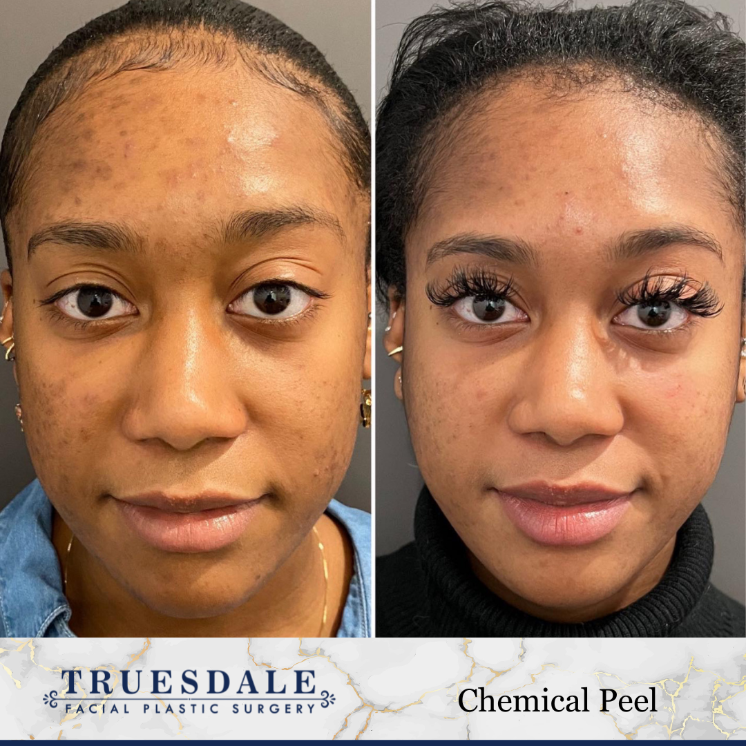 Truesdale Facial Plastic Surgery Before and After Gallery