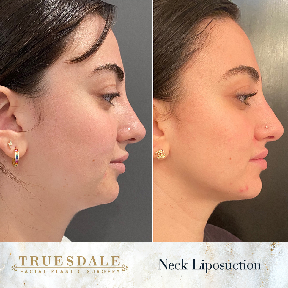 Truesdale Facial Plastic Surgery Before and After Gallery