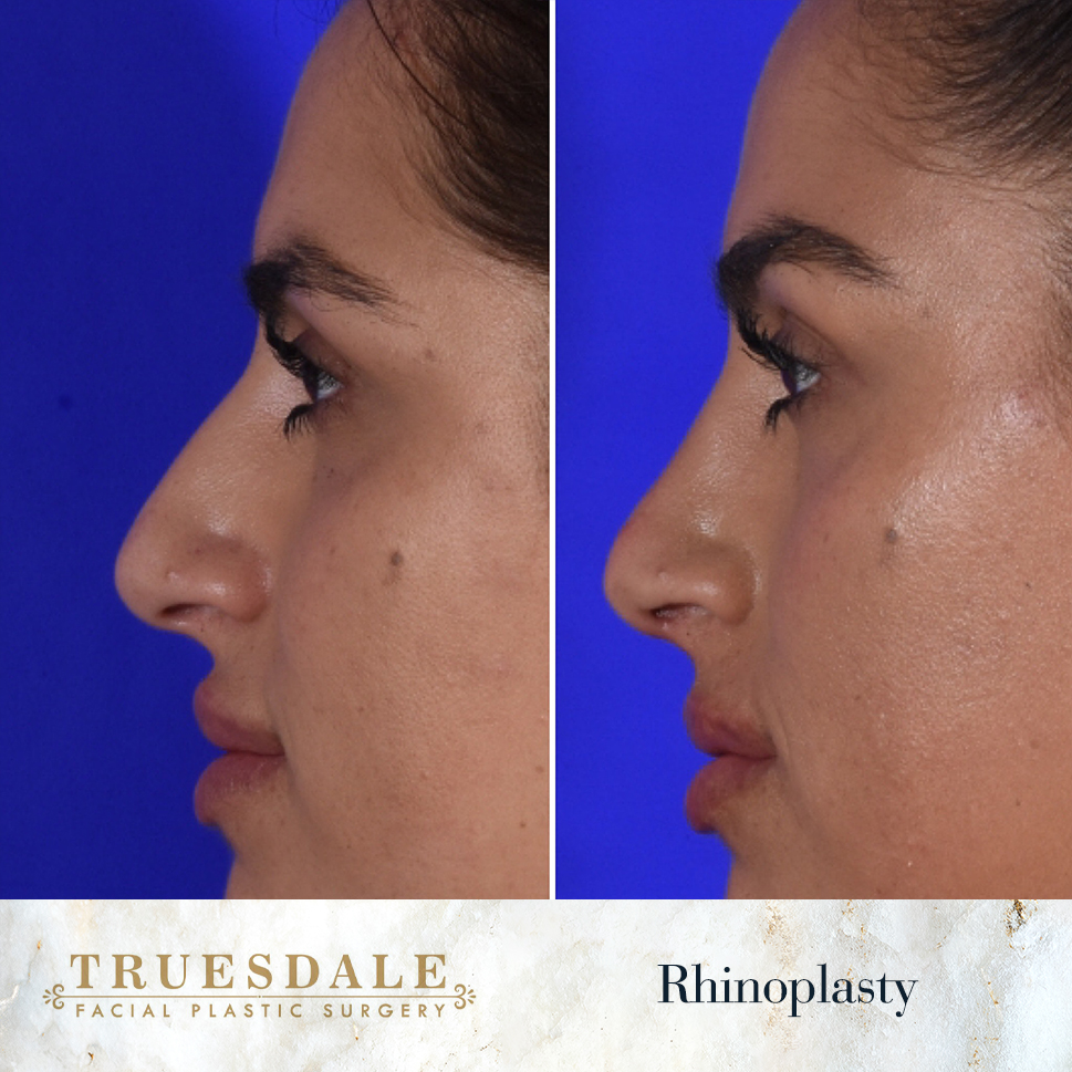 Truesdale Facial Plastic Surgery Before and After Gallery