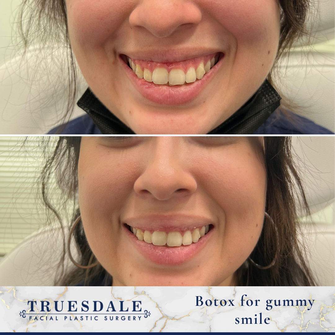 Botox REVISED Truesdale Facial Plastic Surgery Before and After Gallery