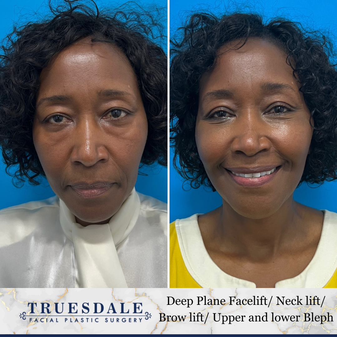 Truesdale Facial Plastic Surgery Before and After Gallery