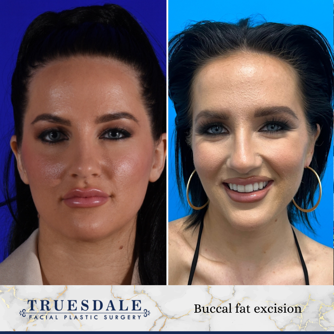 Truesdale Facial Plastic Surgery Before and After Gallery