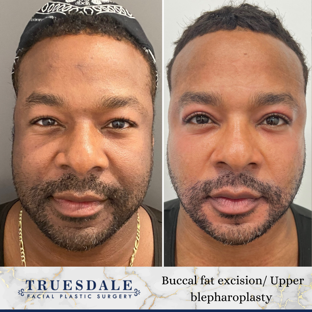 Truesdale Facial Plastic Surgery Before and After Gallery