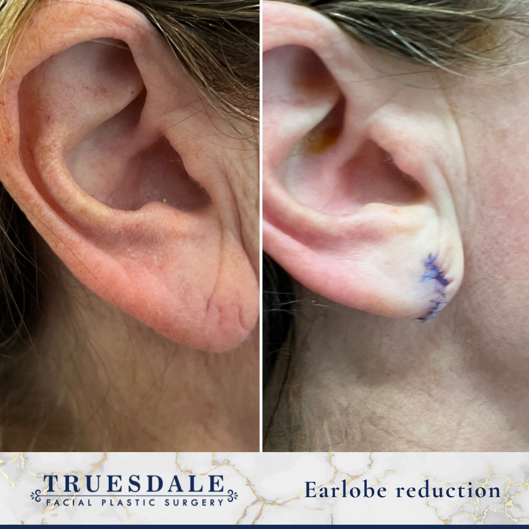 Earlobe Repair And Reduction Gallery