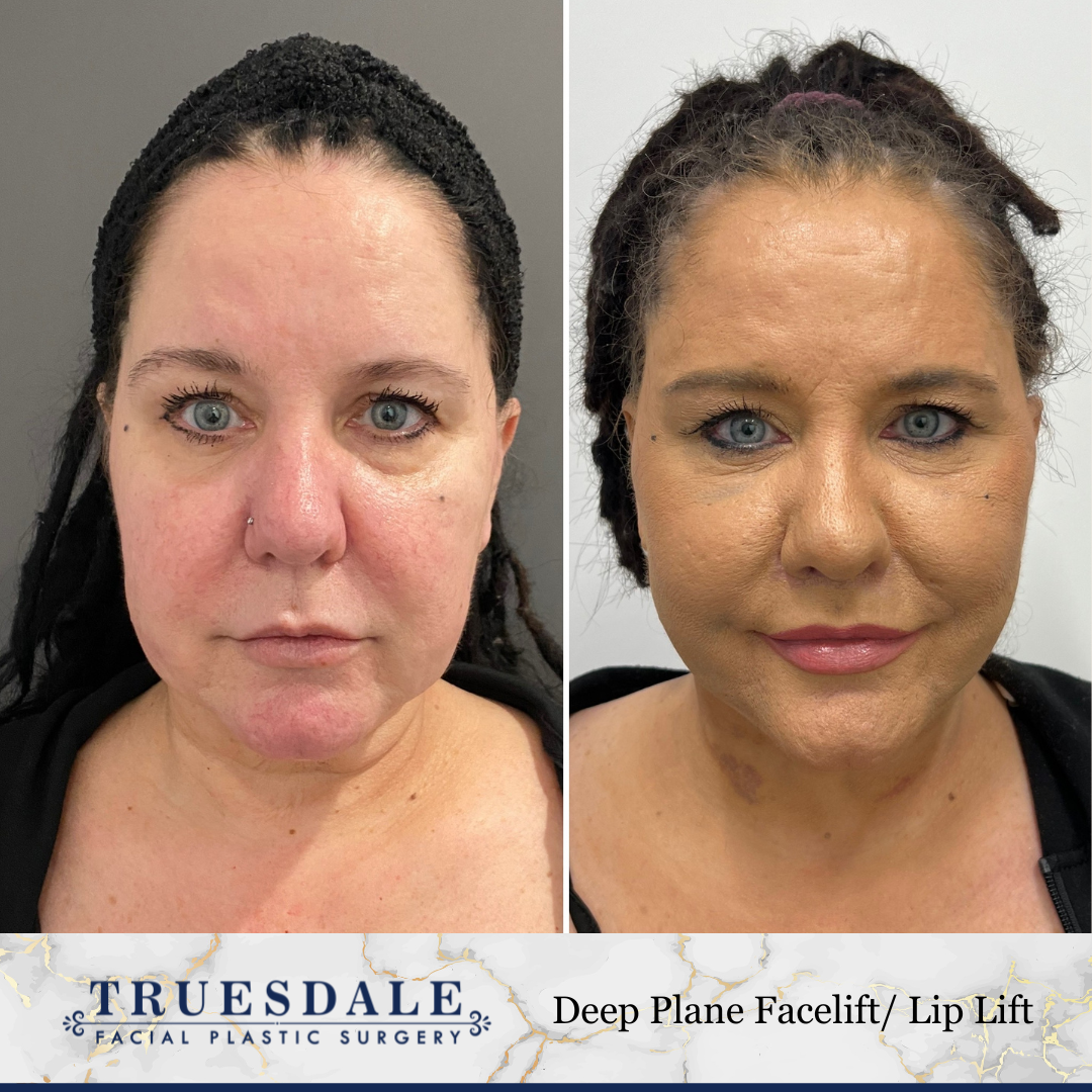 Deep Plane Facelift Truesdale Facial Plastic Surgery Before and After Gallery