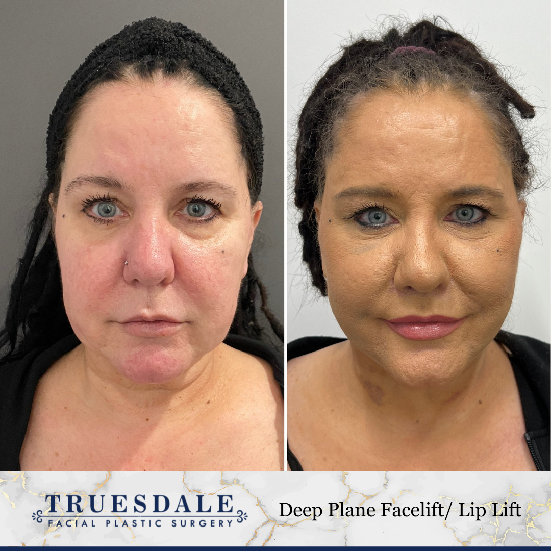 Truesdale Facial Plastic Surgery Before and After Gallery