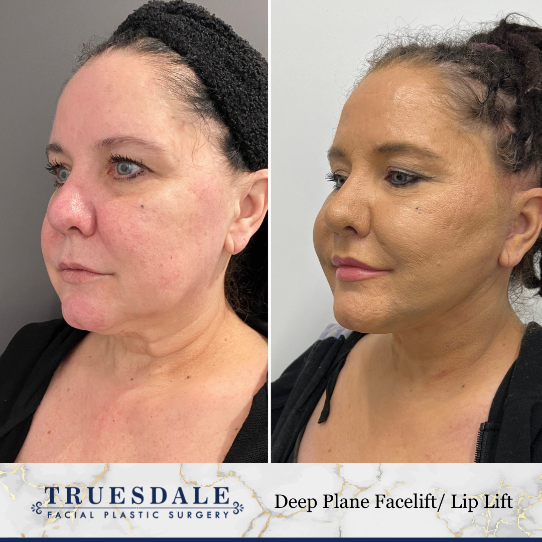 Deep Plane Facelift Truesdale Facial Plastic Surgery Before and After Gallery