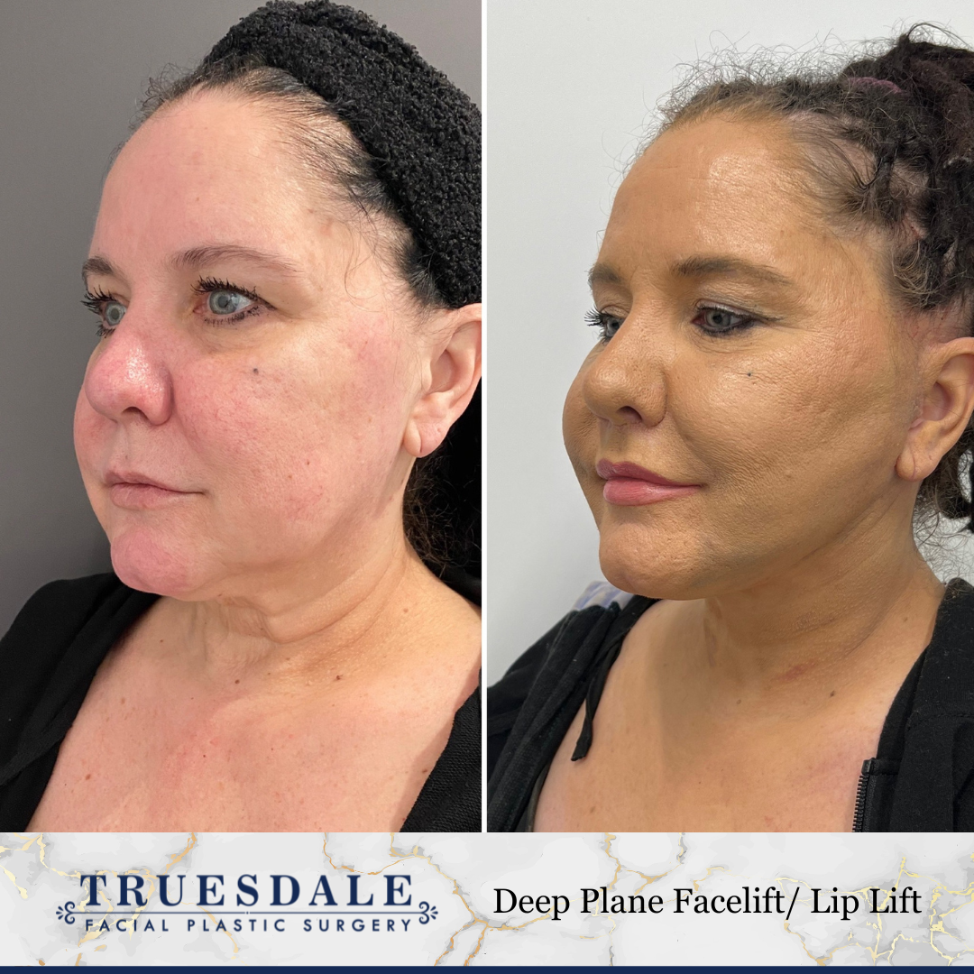 Truesdale Facial Plastic Surgery Before and After Gallery